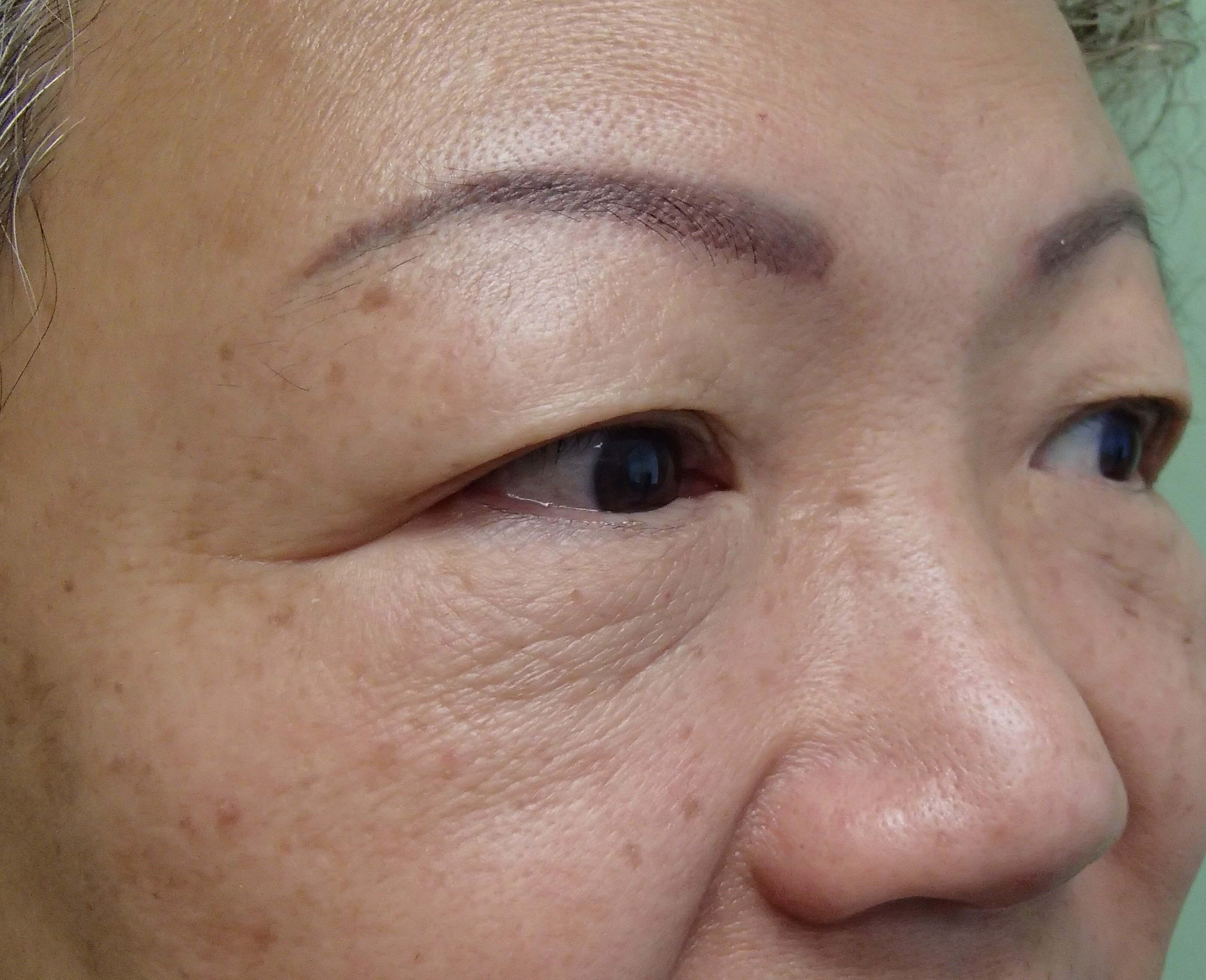 Asian Eyelid Lift Before