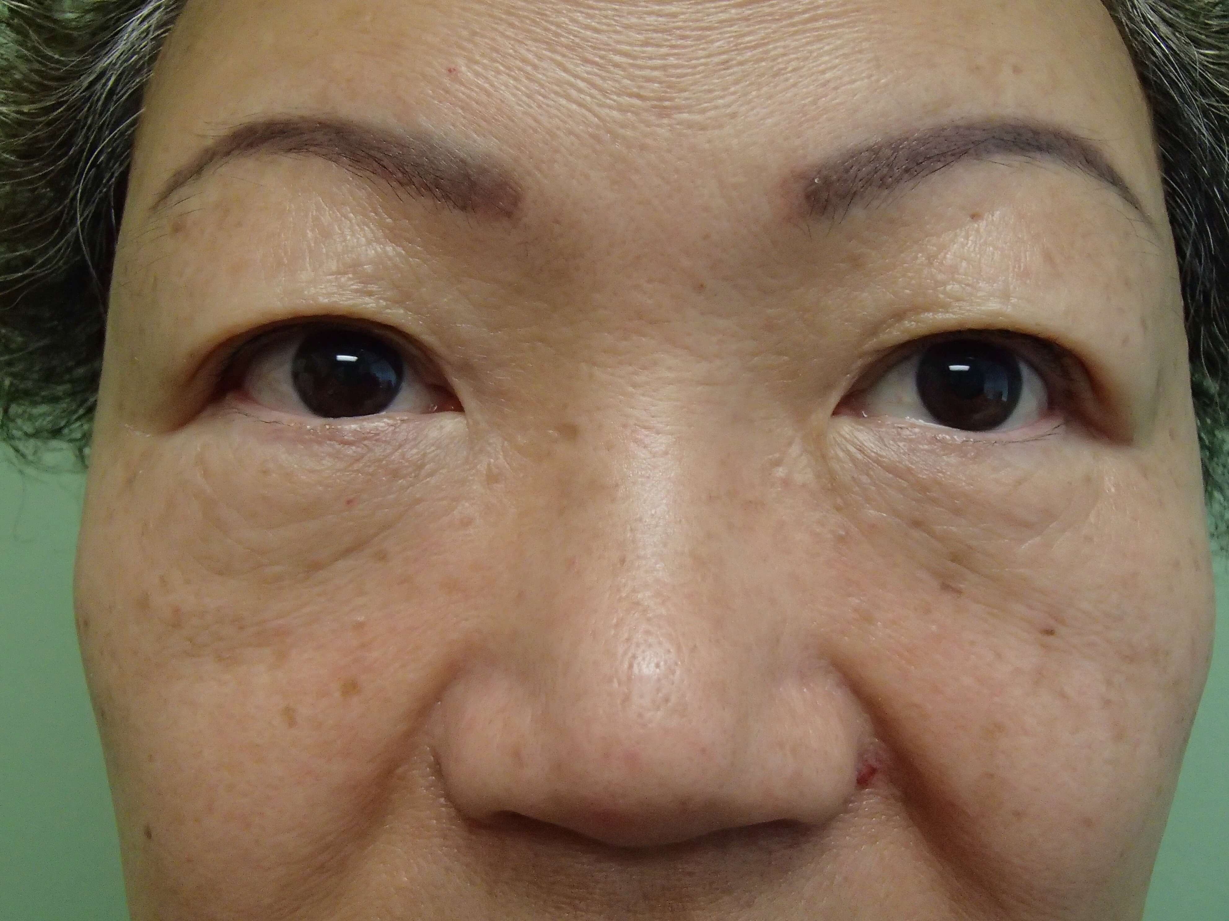Asian Eyelid Lift Before