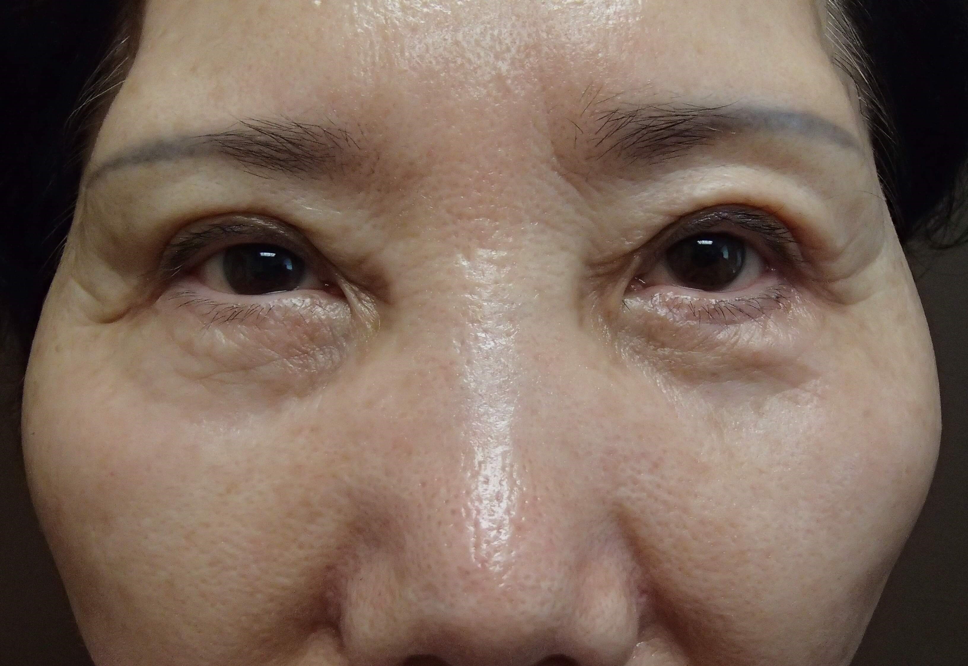 Asian Eyelid Lift After