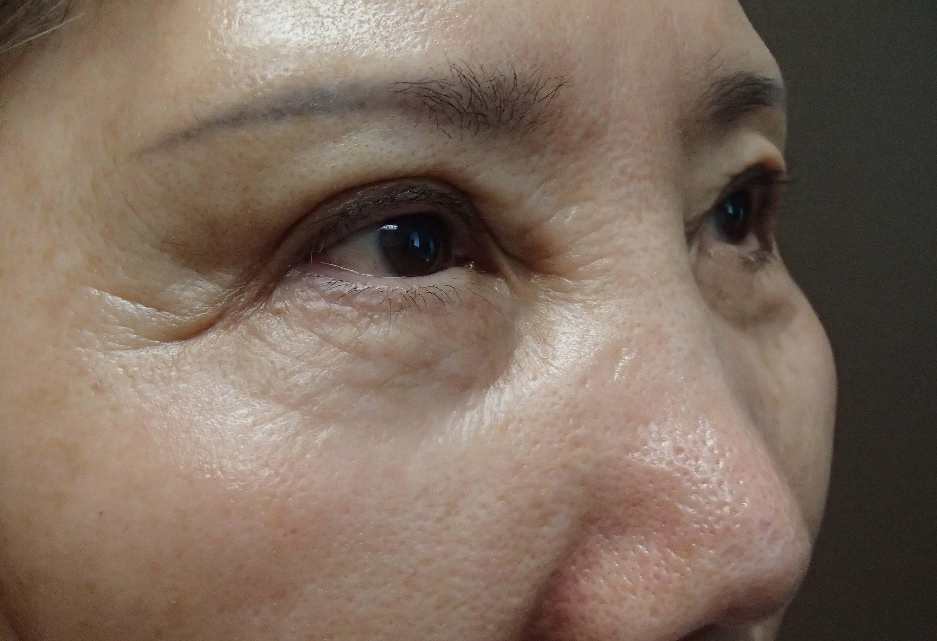 Asian Eyelid Lift After