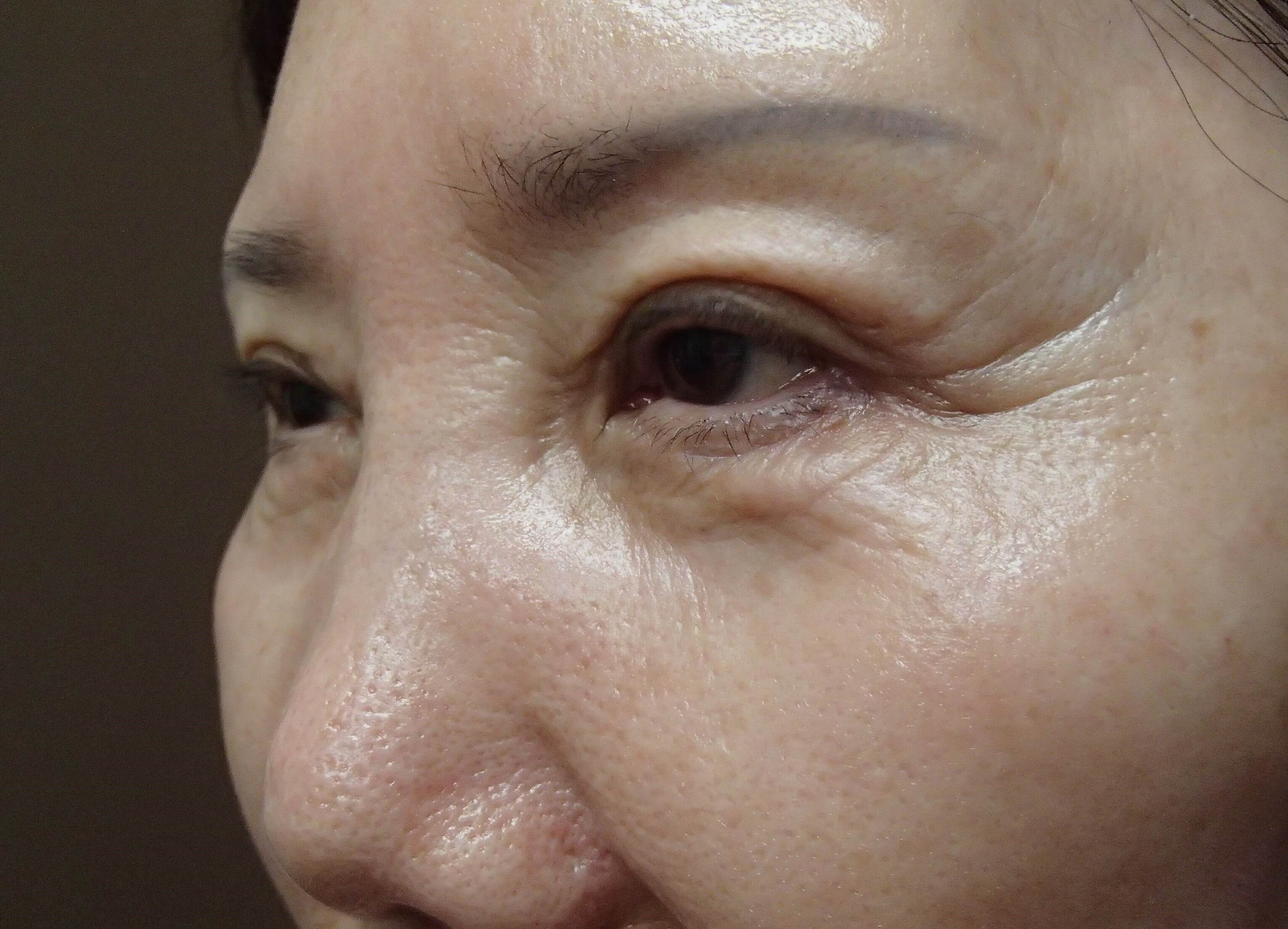 Asian Eyelid Lift After