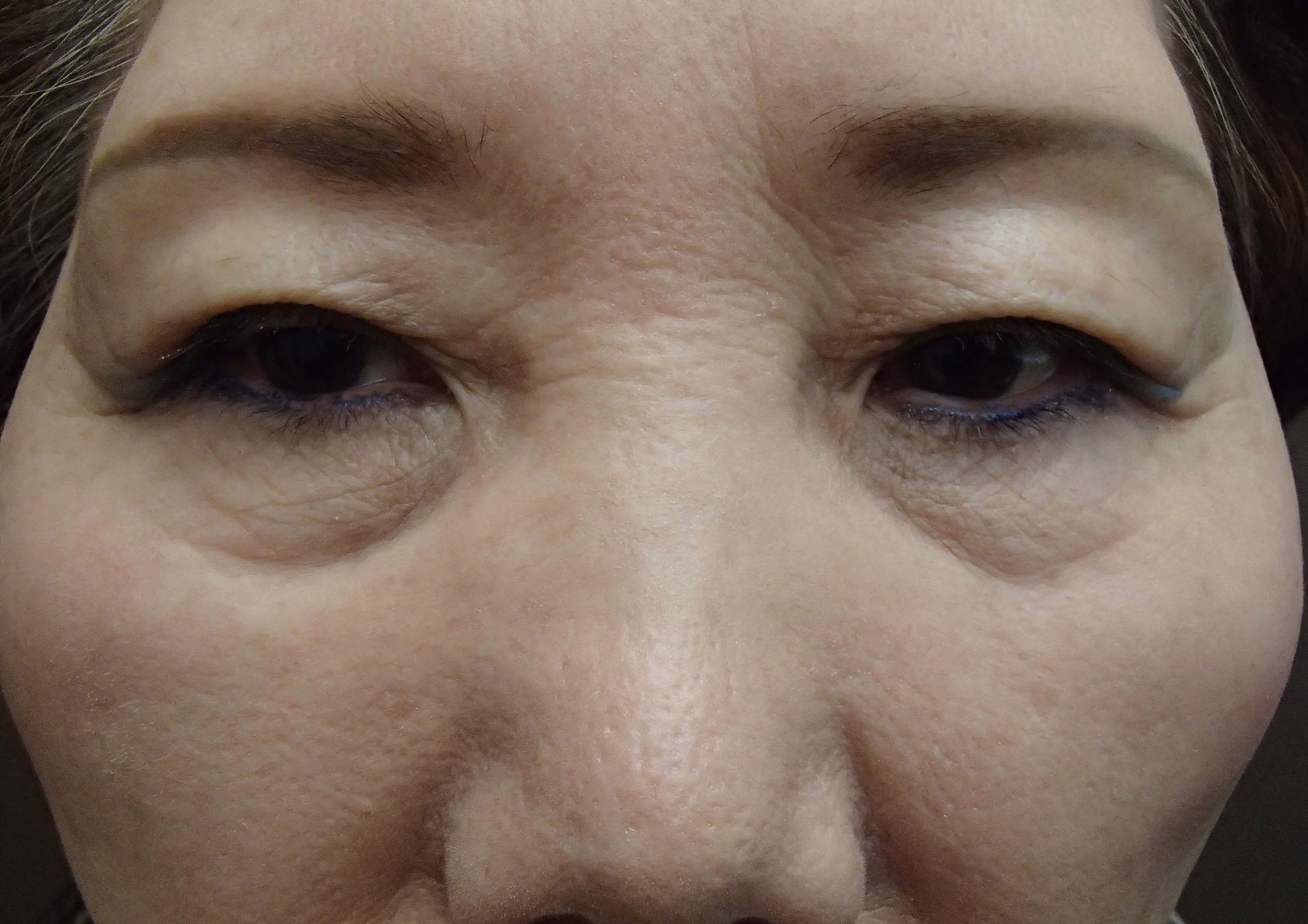 Asian Eyelid Lift Before