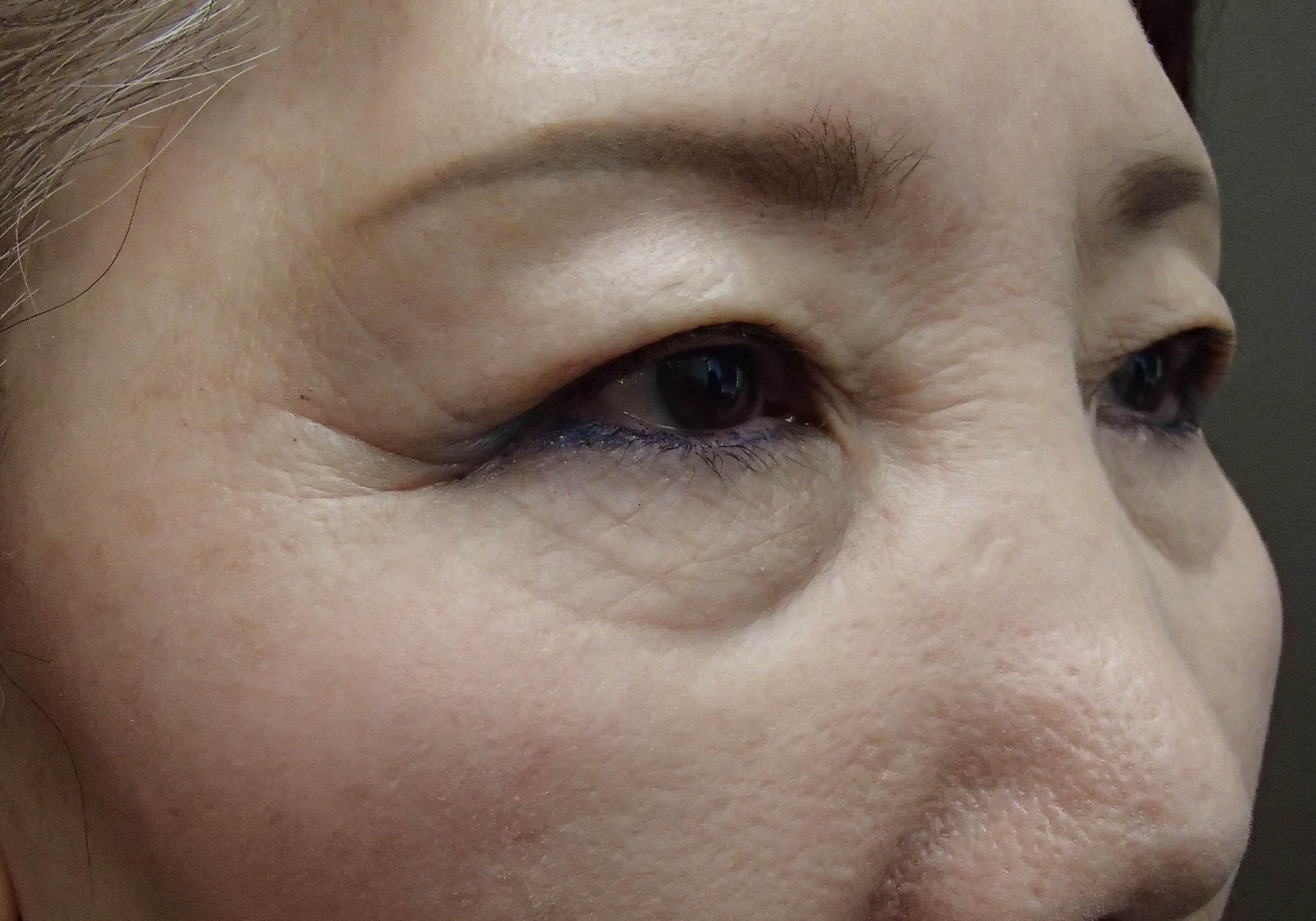 Asian Eyelid Lift Before