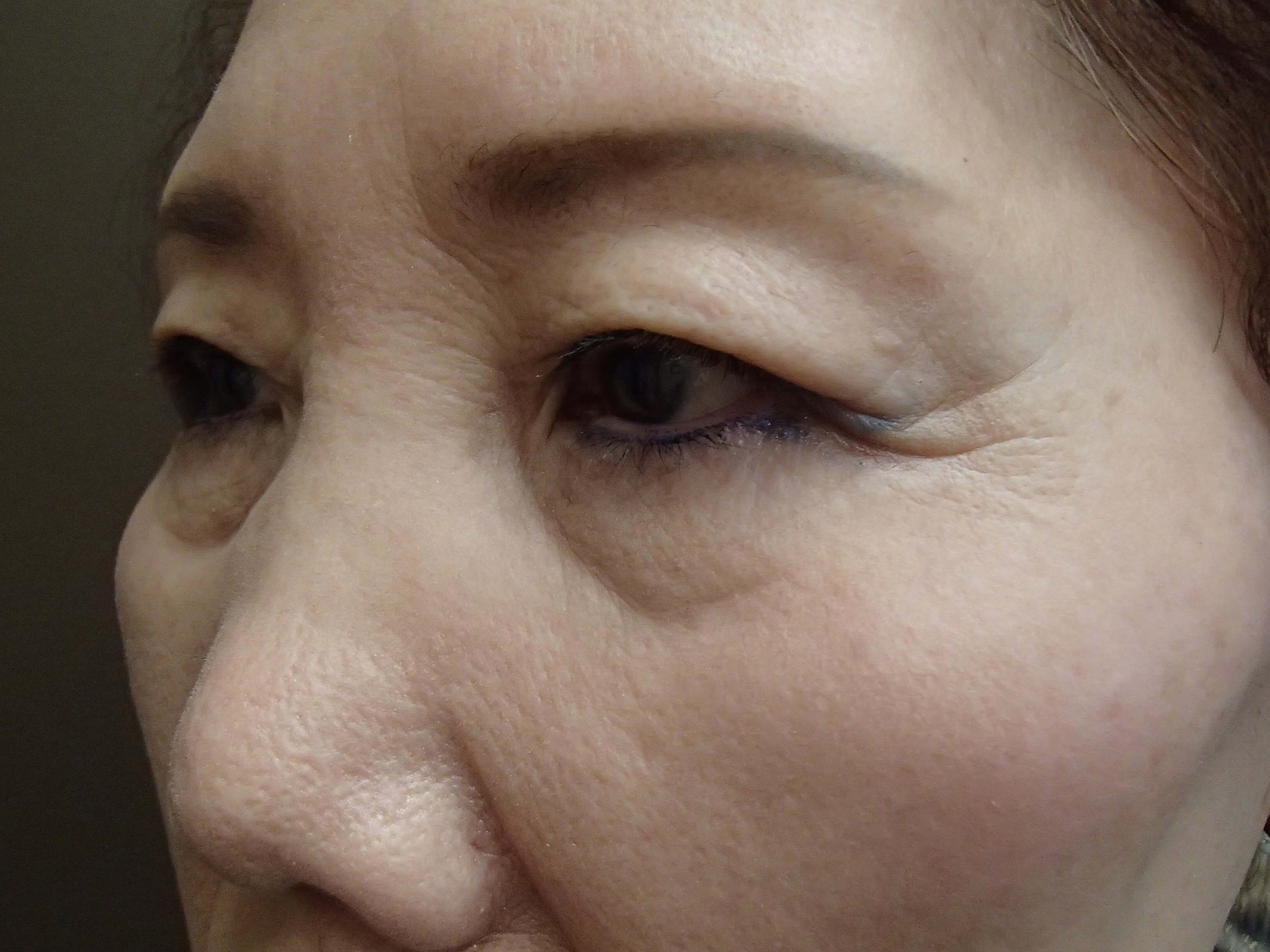 Asian Eyelid Lift Before