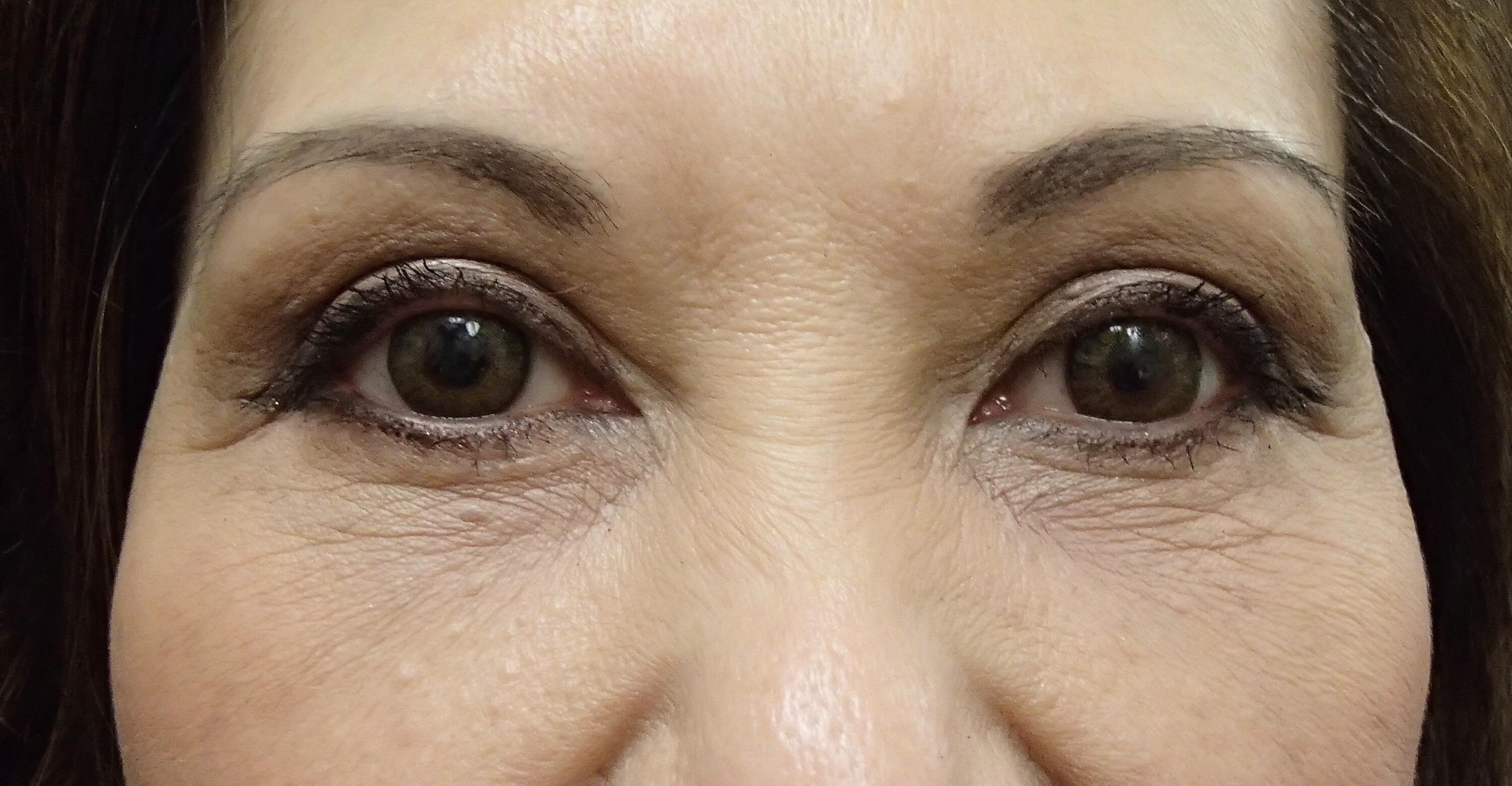 Asian Eyelid Lift After