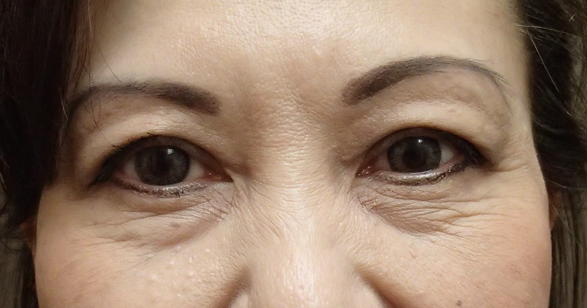 Asian Eyelid Lift Before