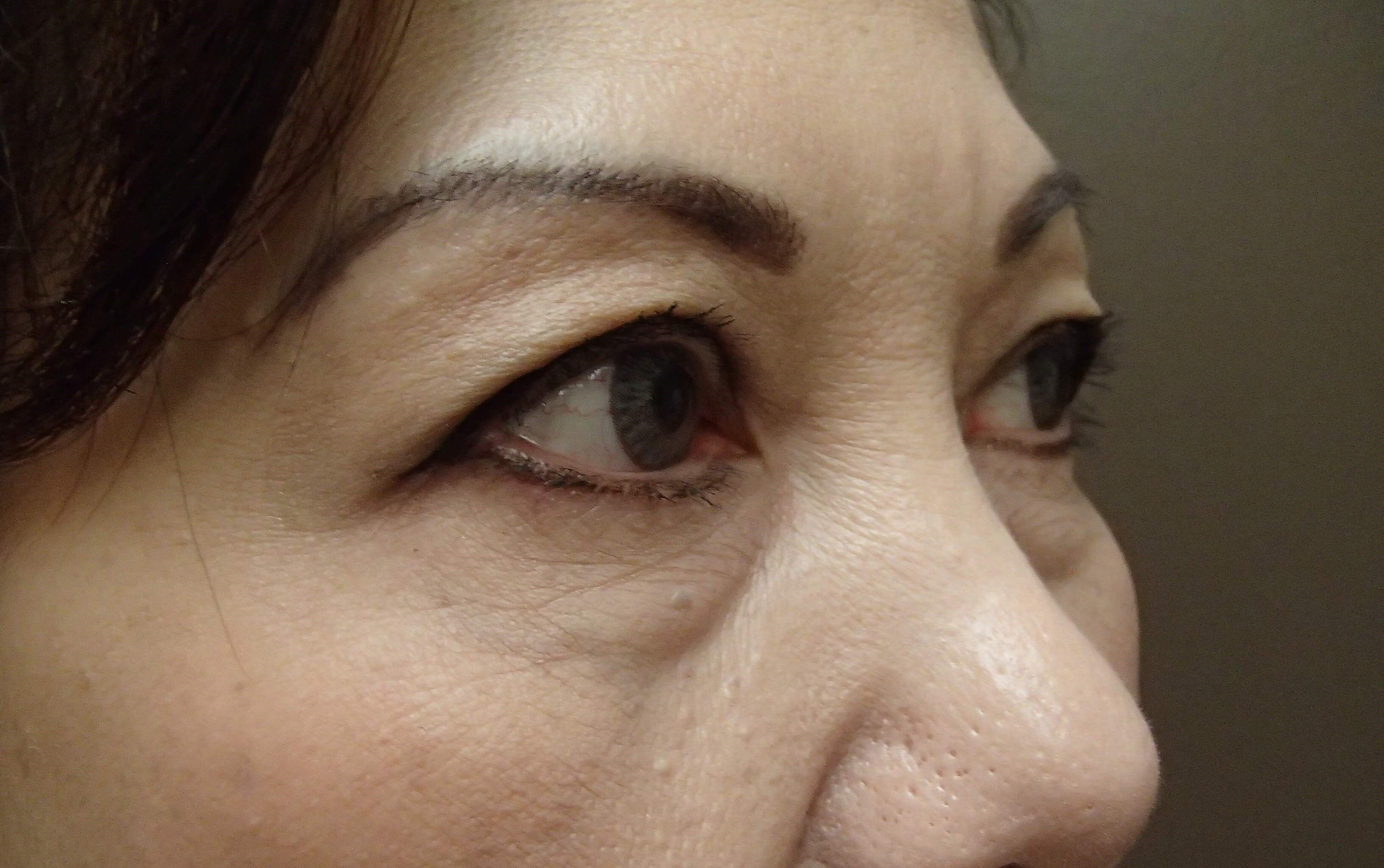 Asian Eyelid Lift Before