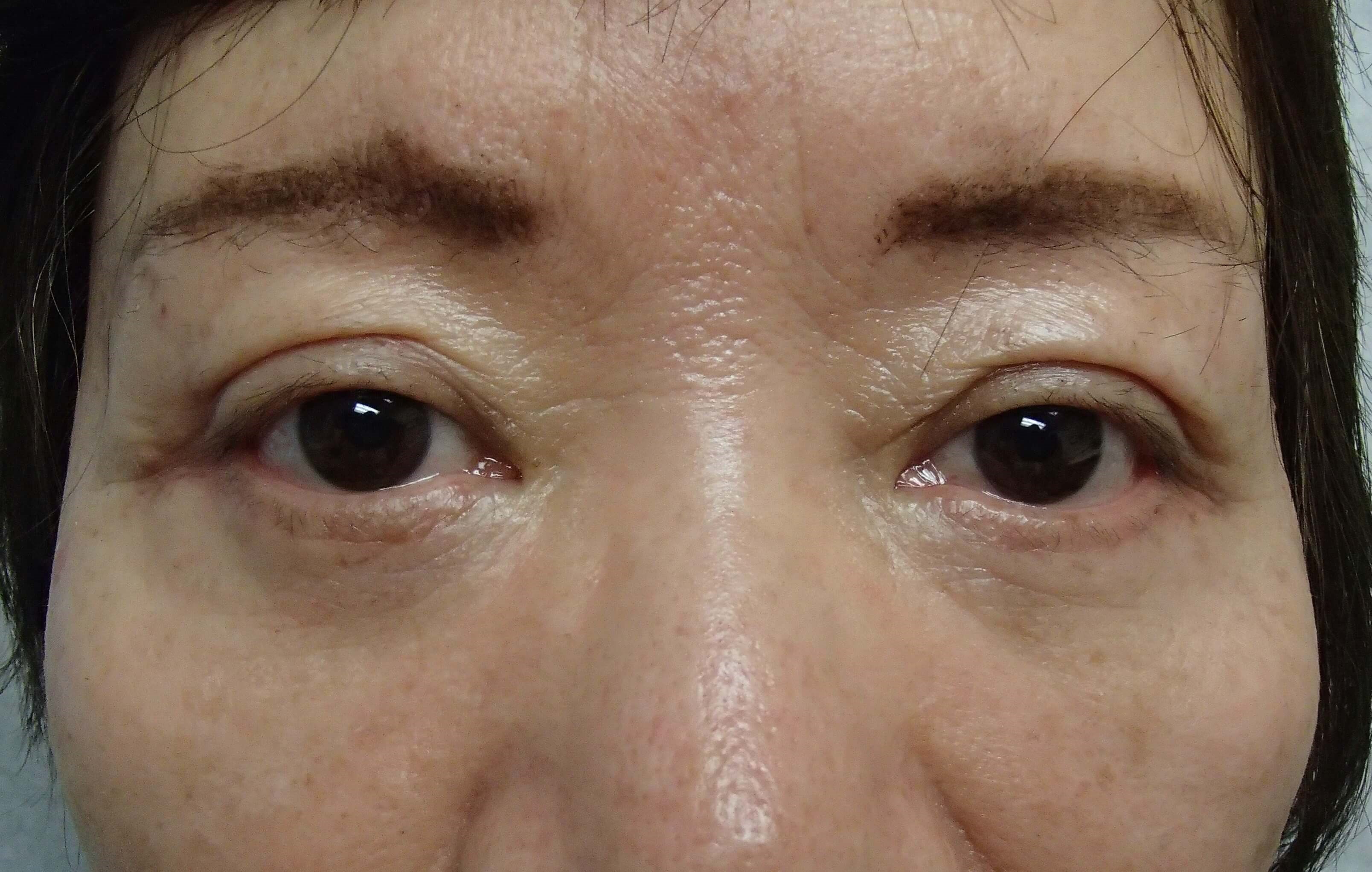 Asian Eyelid Lift After