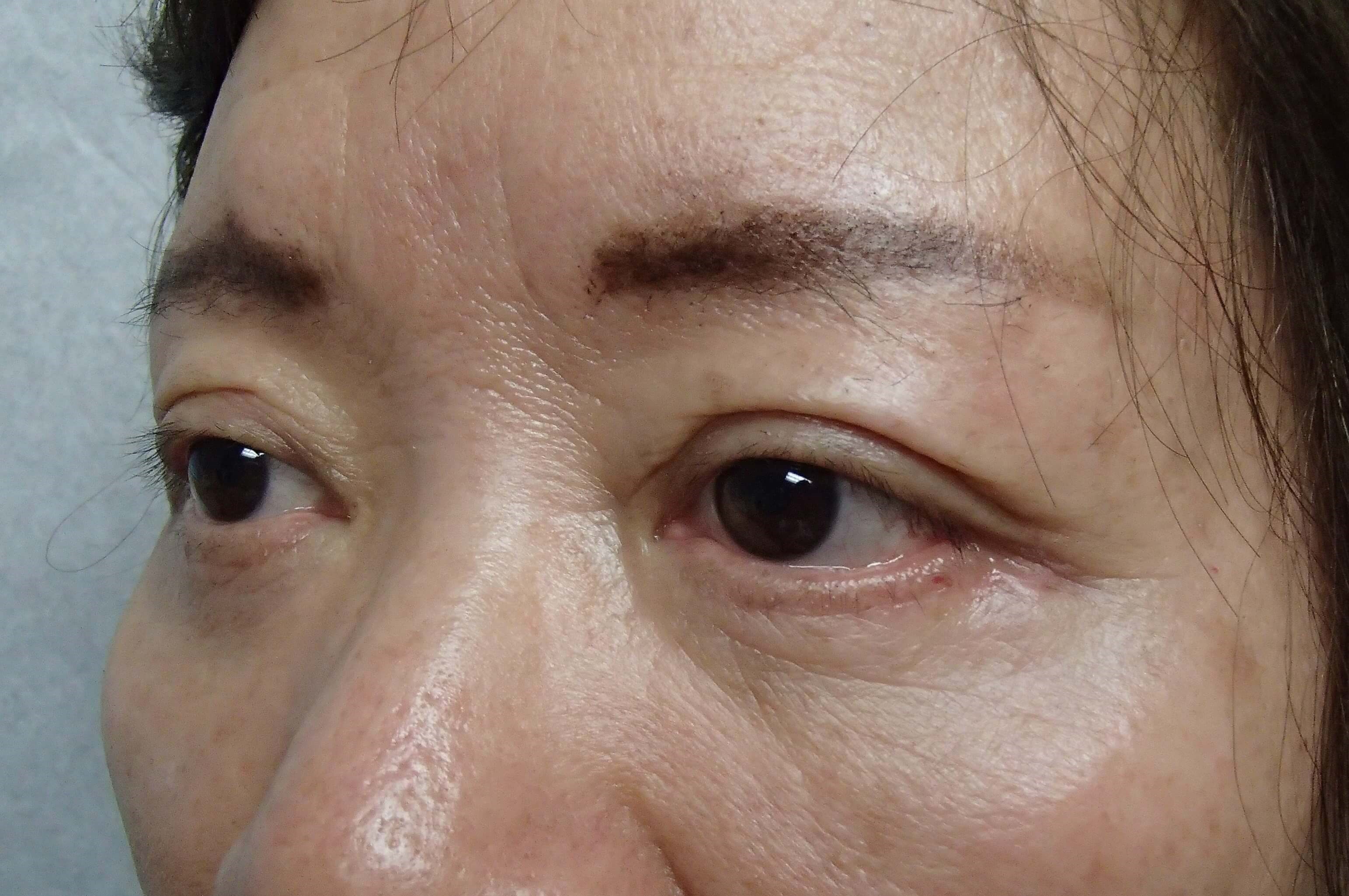 Asian Eyelid Lift After