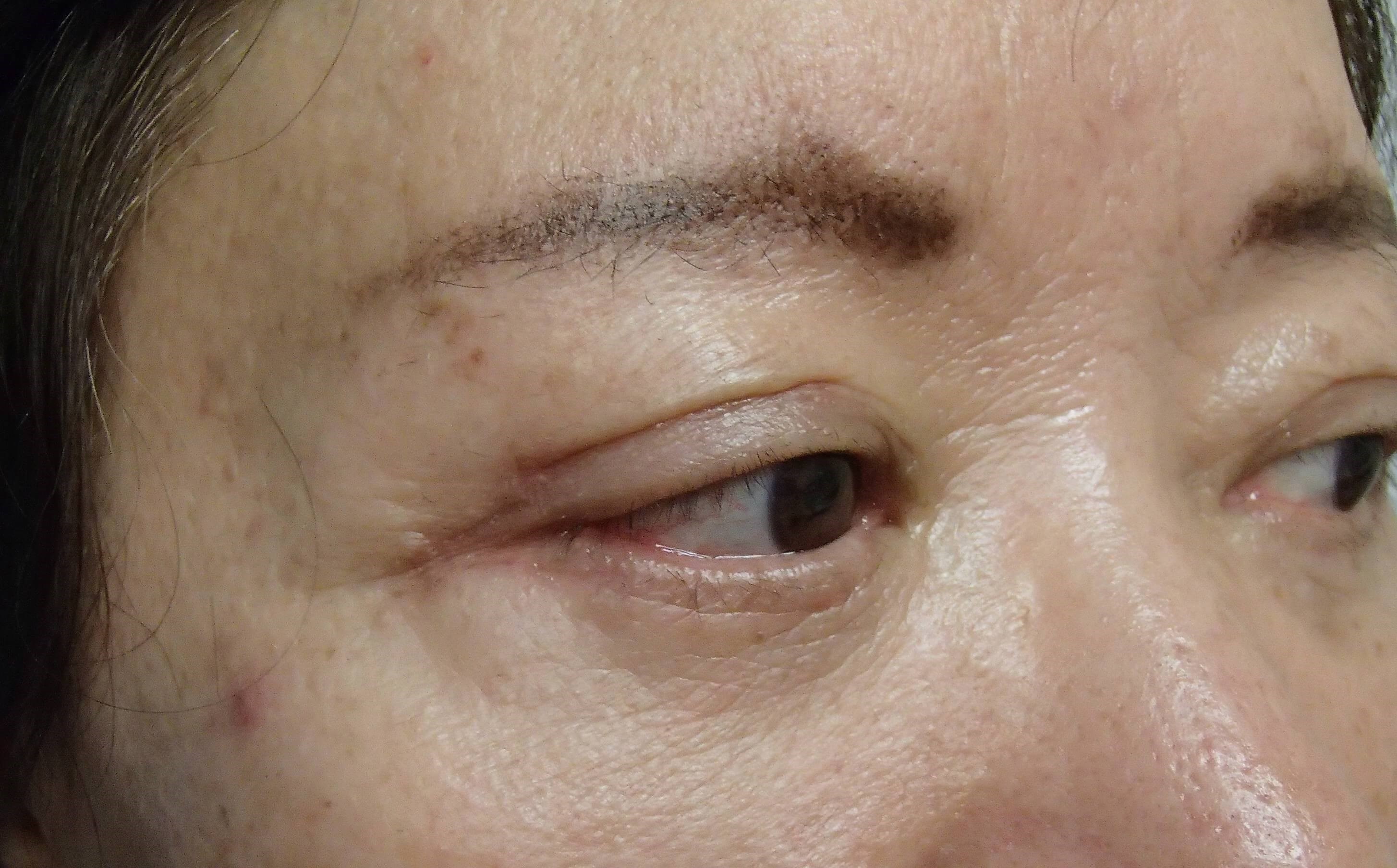 Asian Eyelid Lift After
