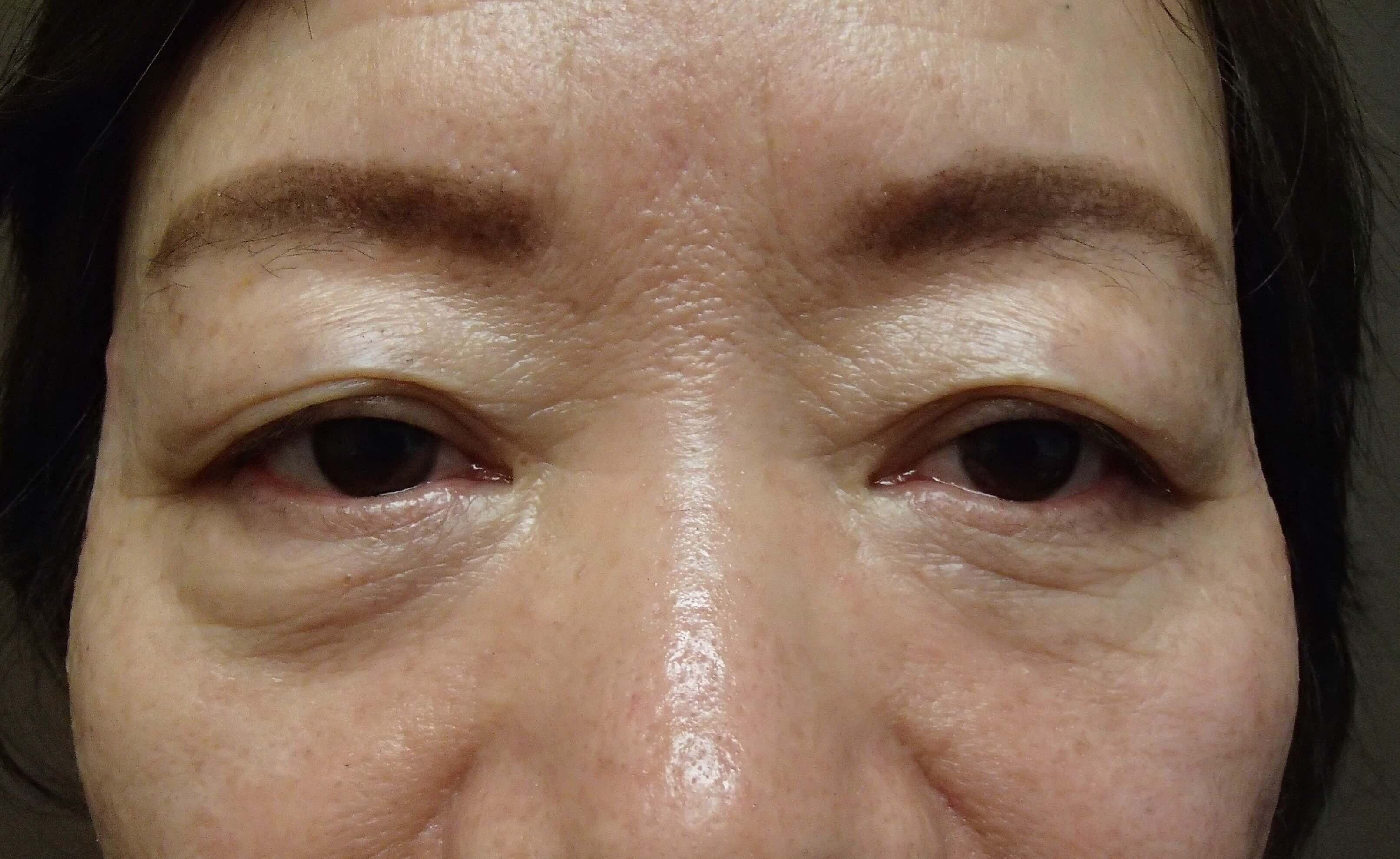 Asian Eyelid Lift Before