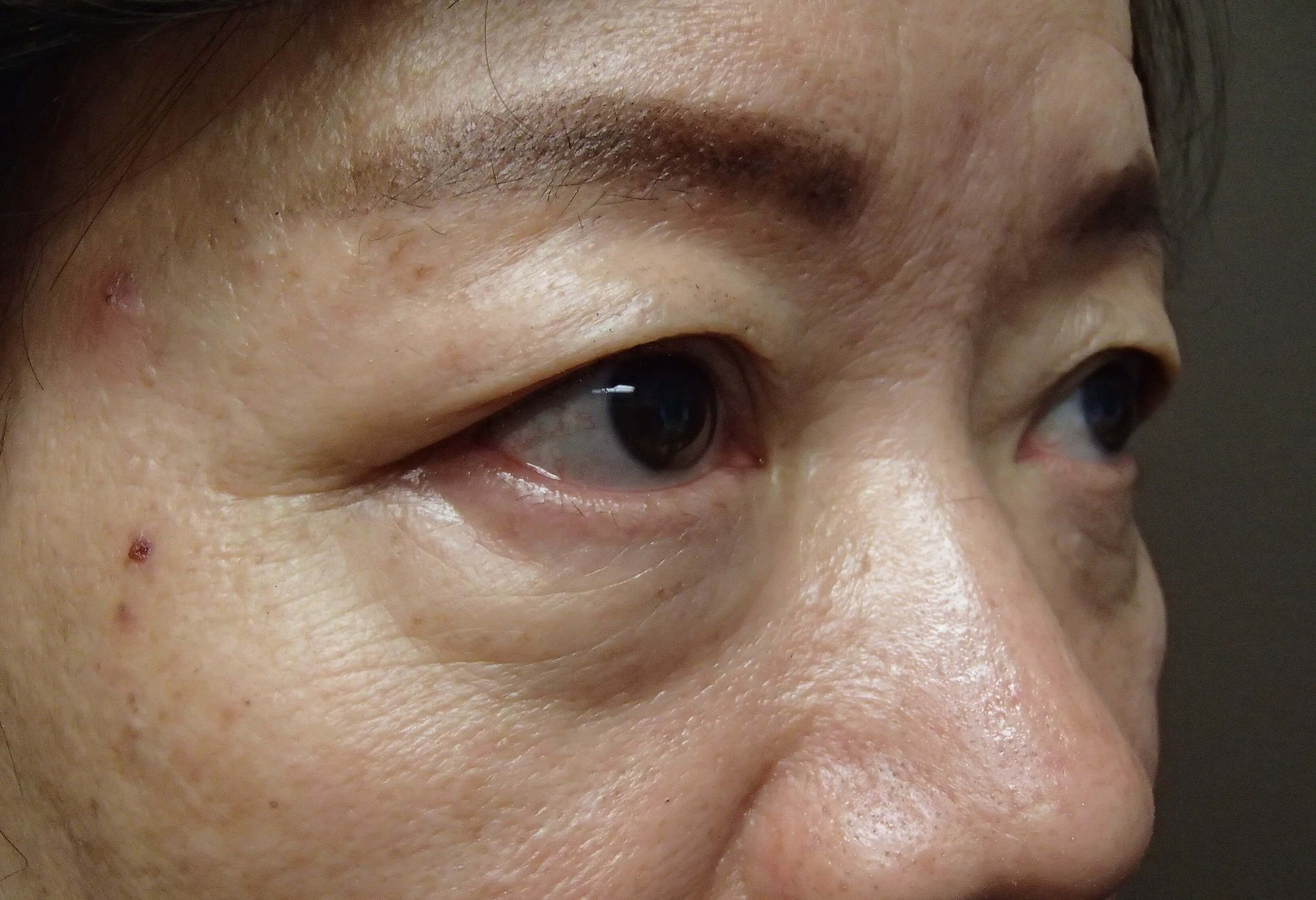 Asian Eyelid Lift Before