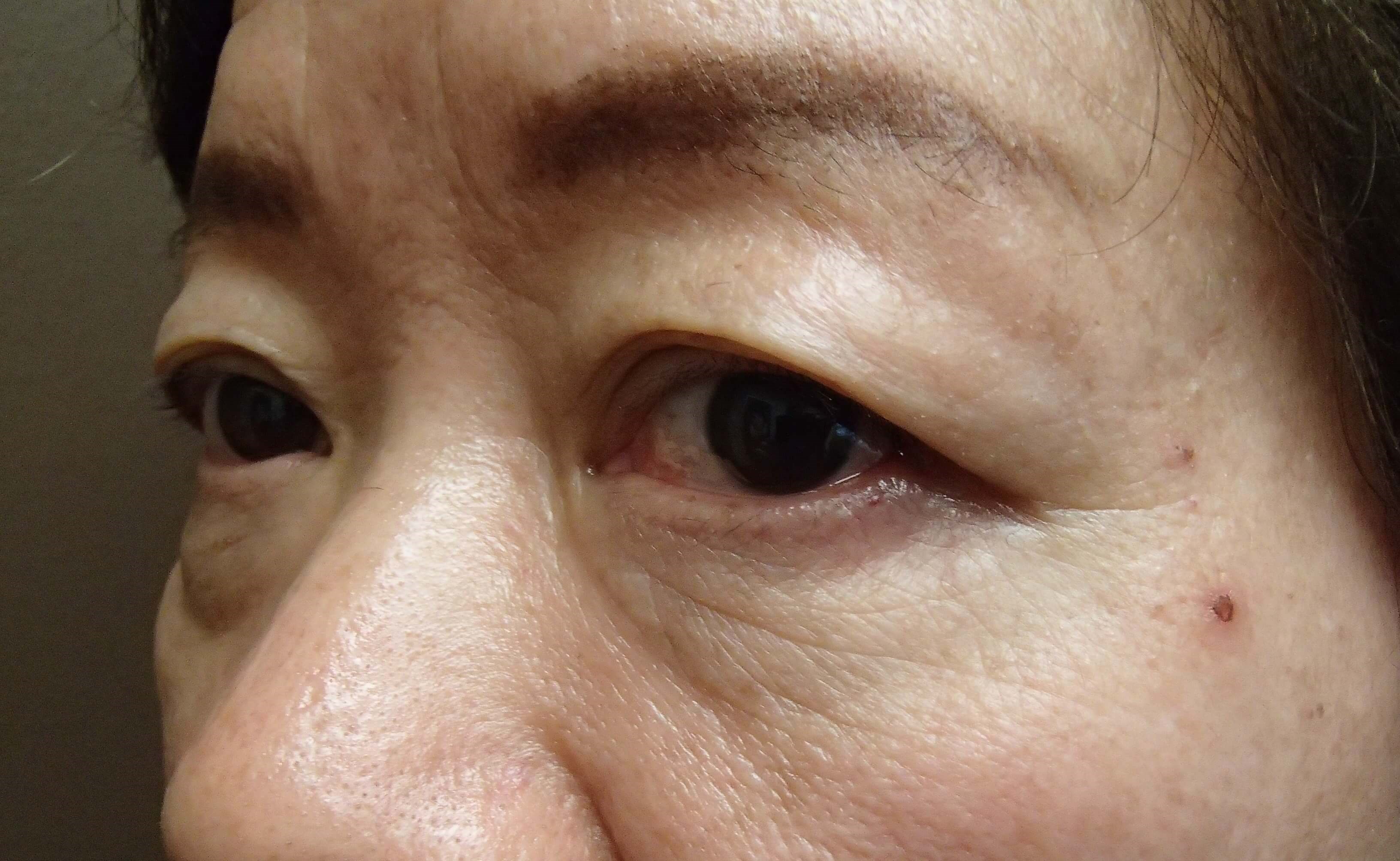 Asian Eyelid Lift Before