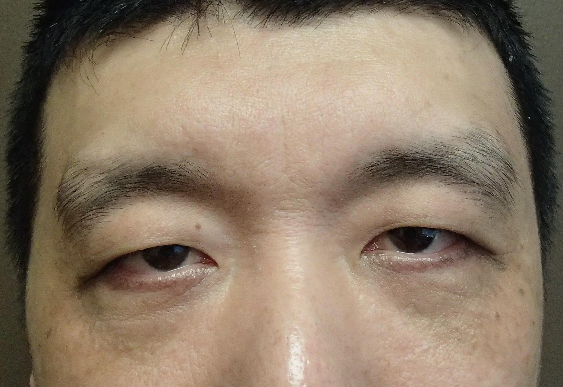 Asian Eyelid Lift Before
