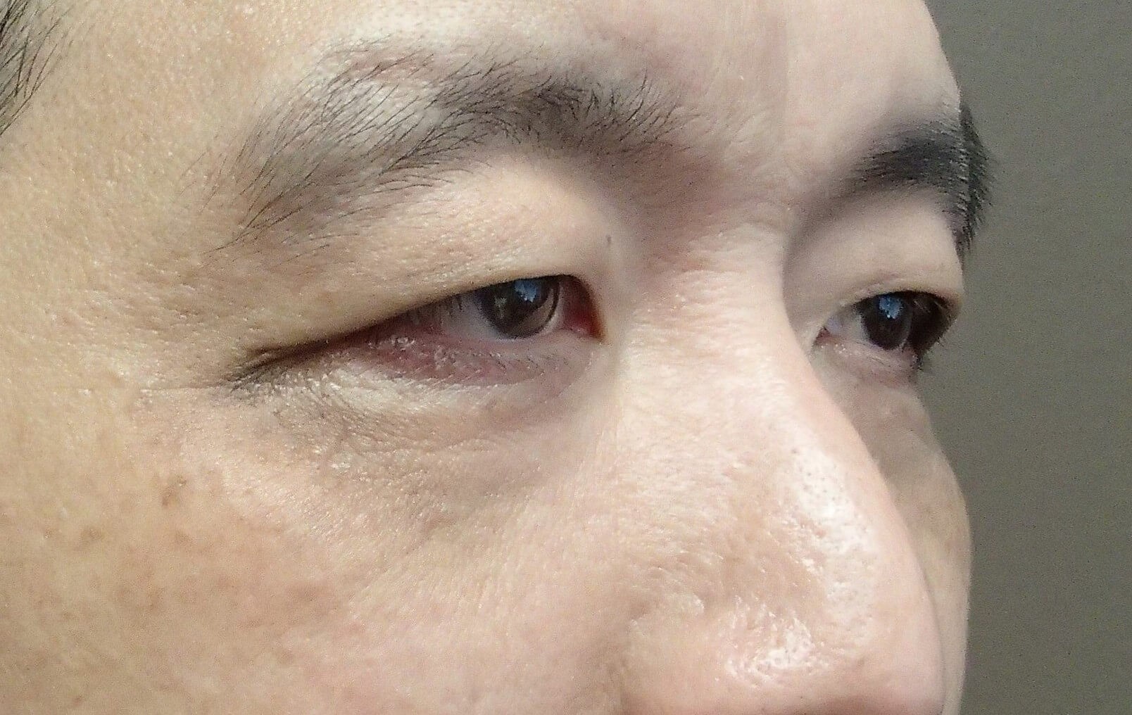 Asian Eyelid Lift Before