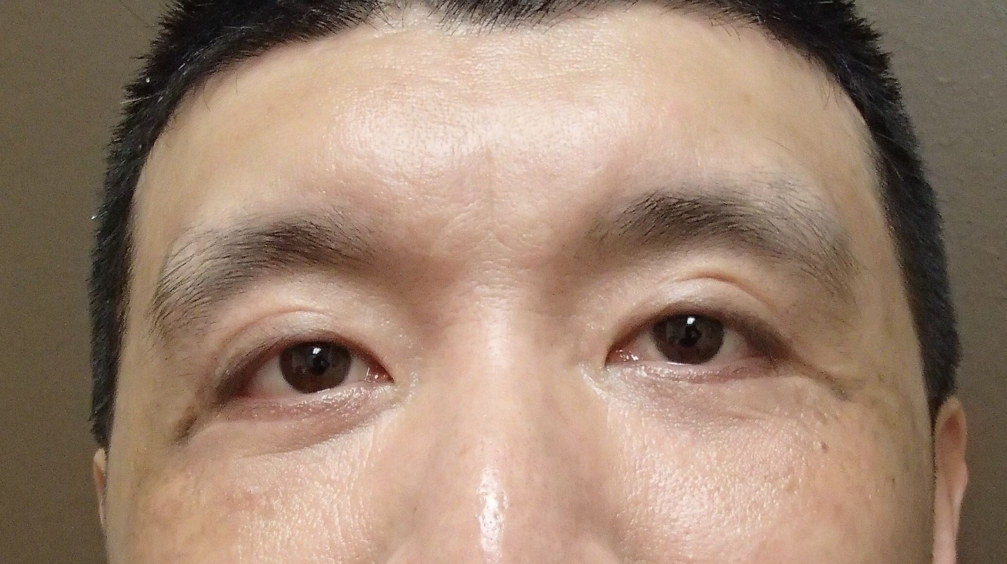 Asian Eyelid Lift After