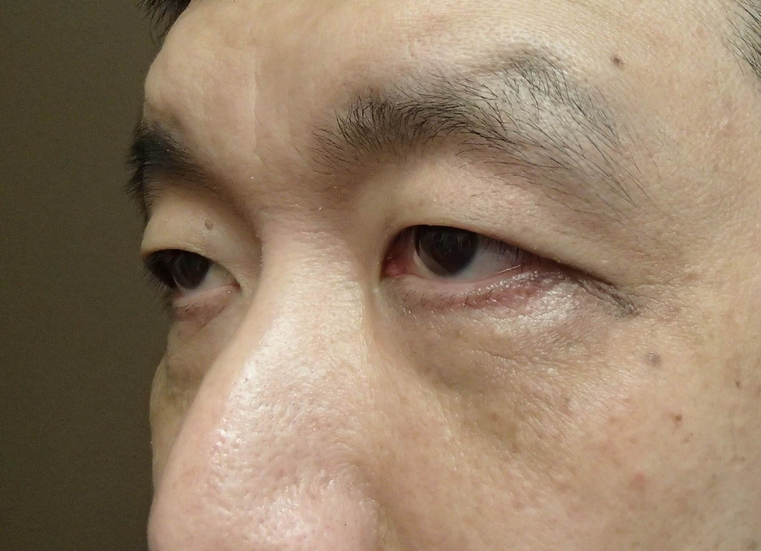 Asian Eyelid Lift Before