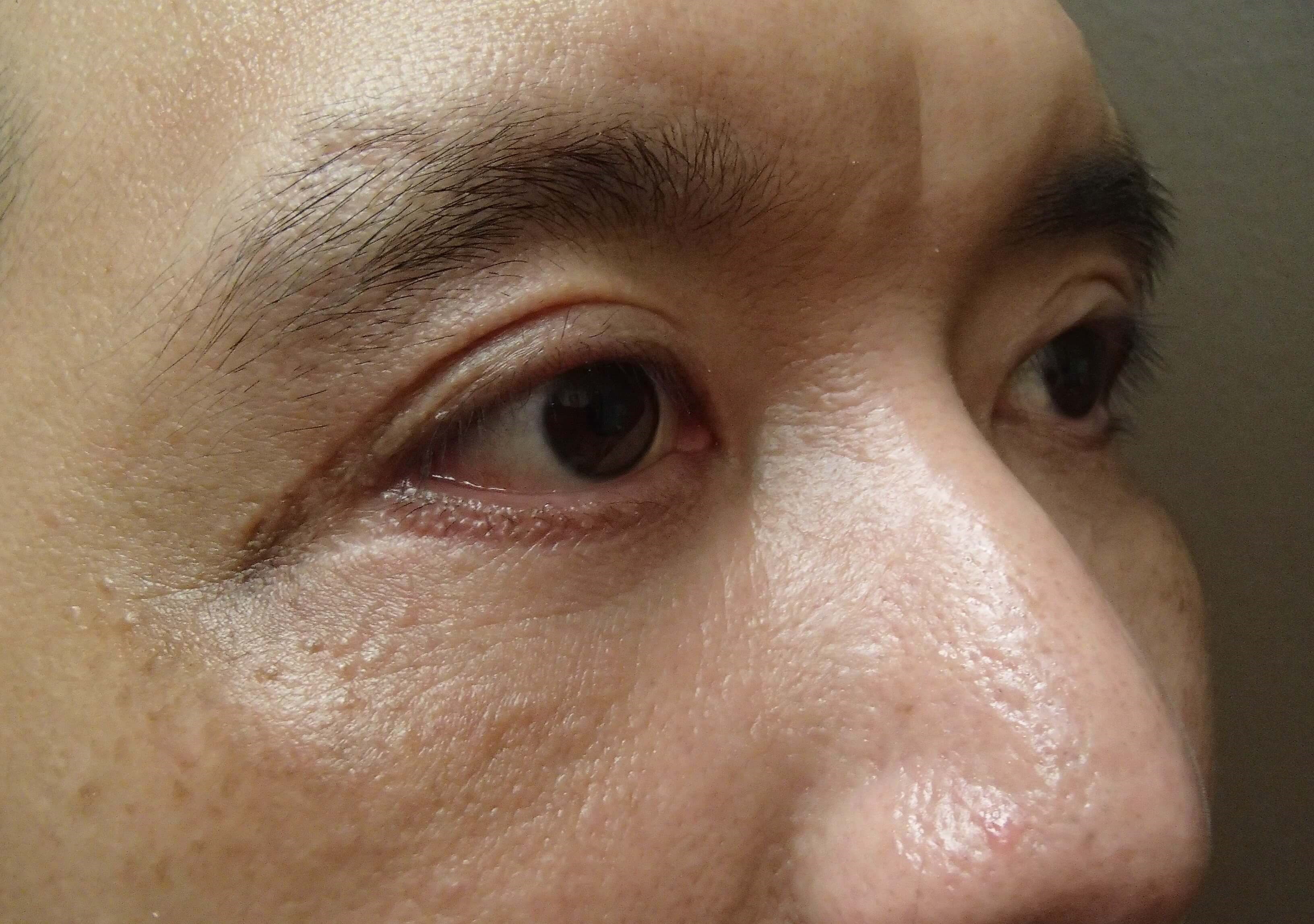 Asian Eyelid Lift After