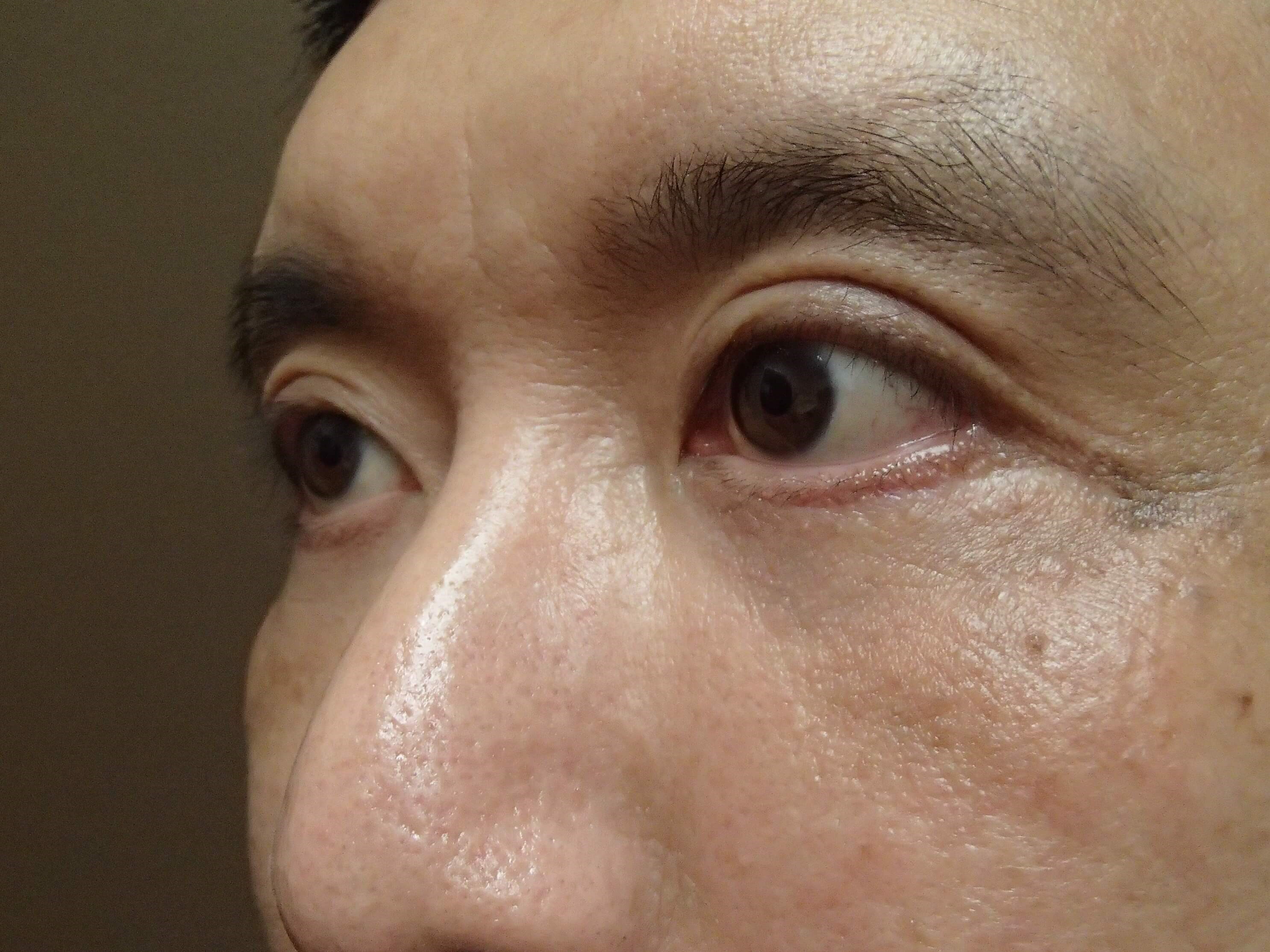 Asian Eyelid Lift After