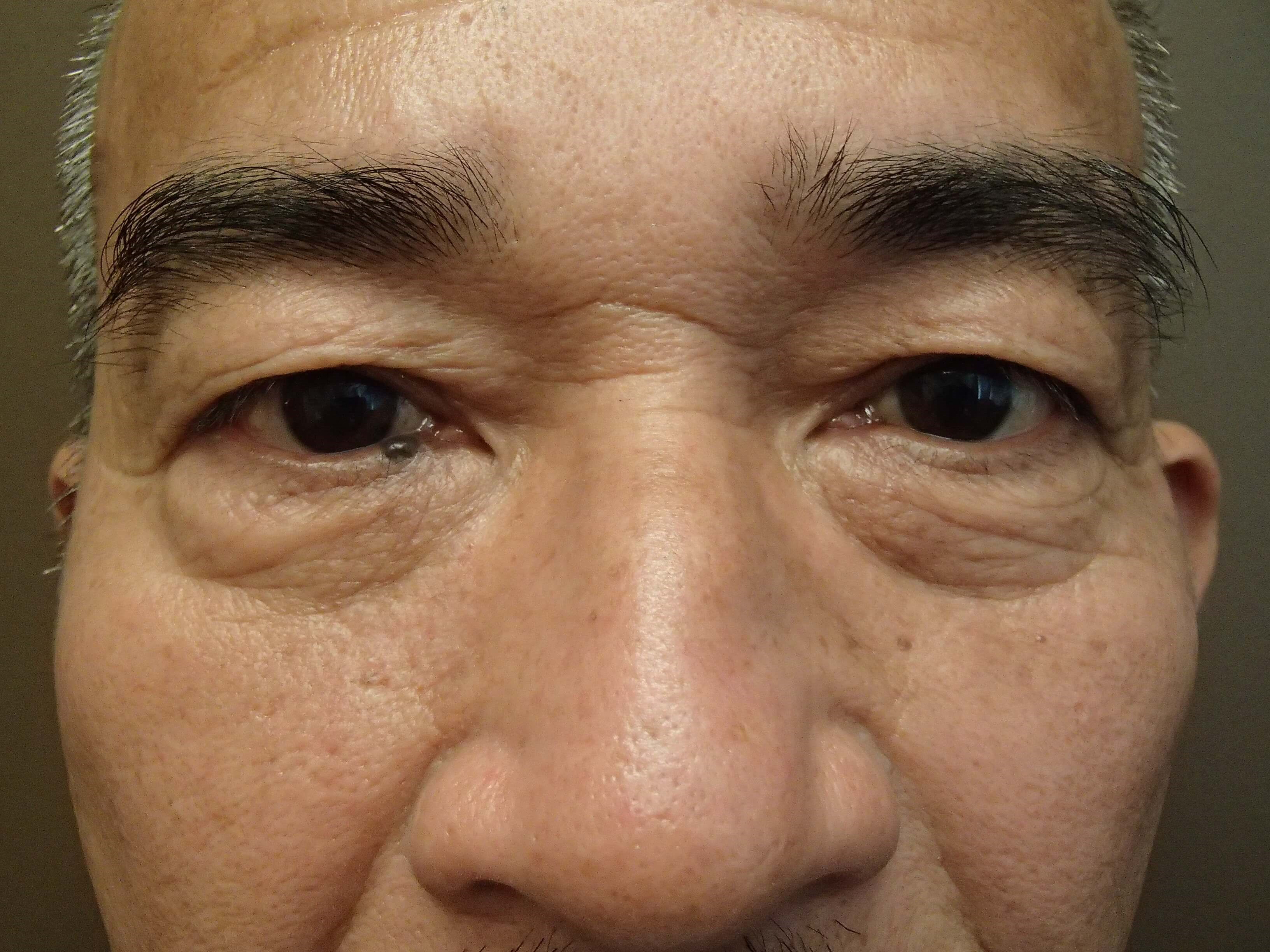 Asian Eyelid Lift Before