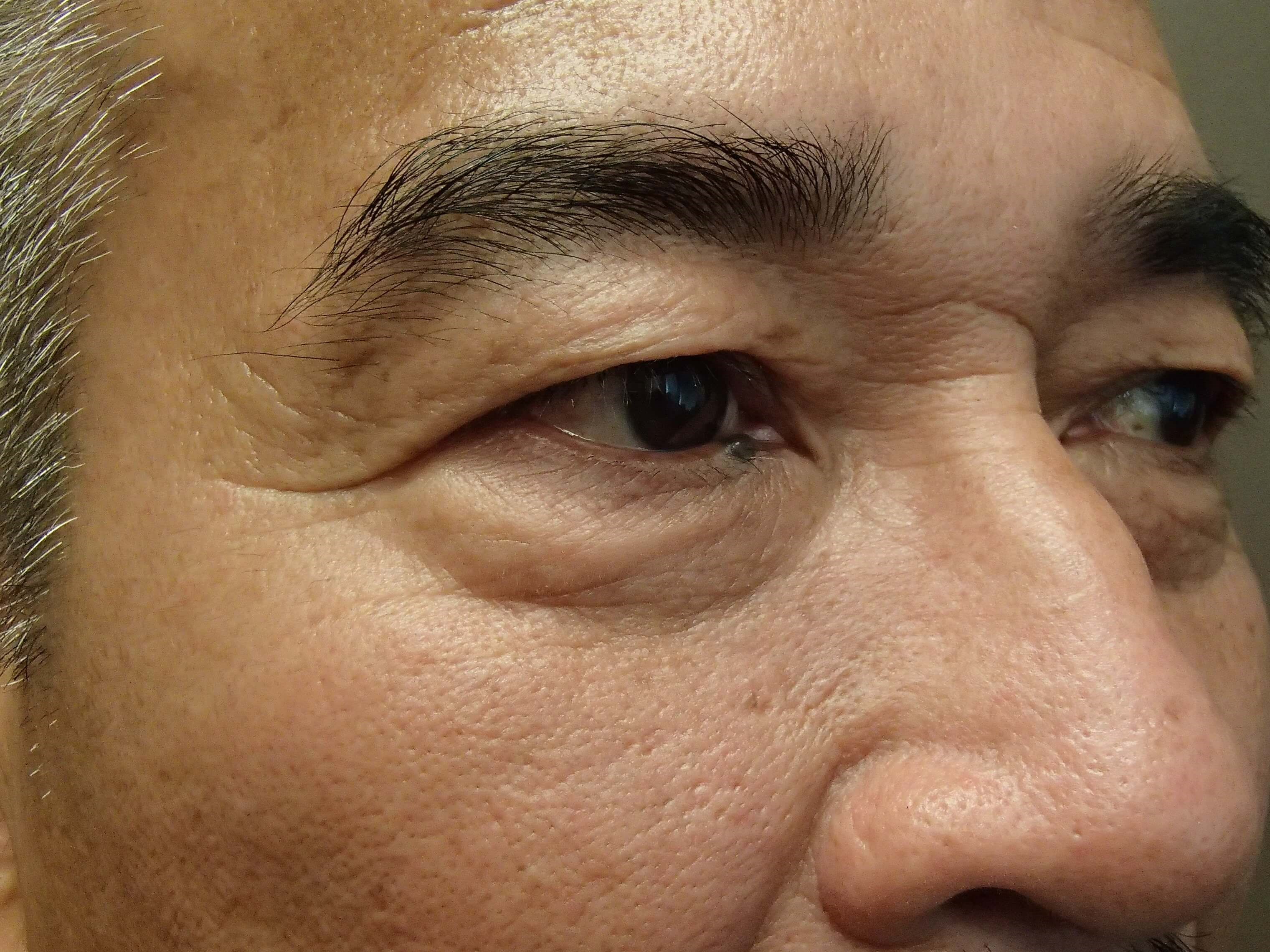 Asian Eyelid Lift Before