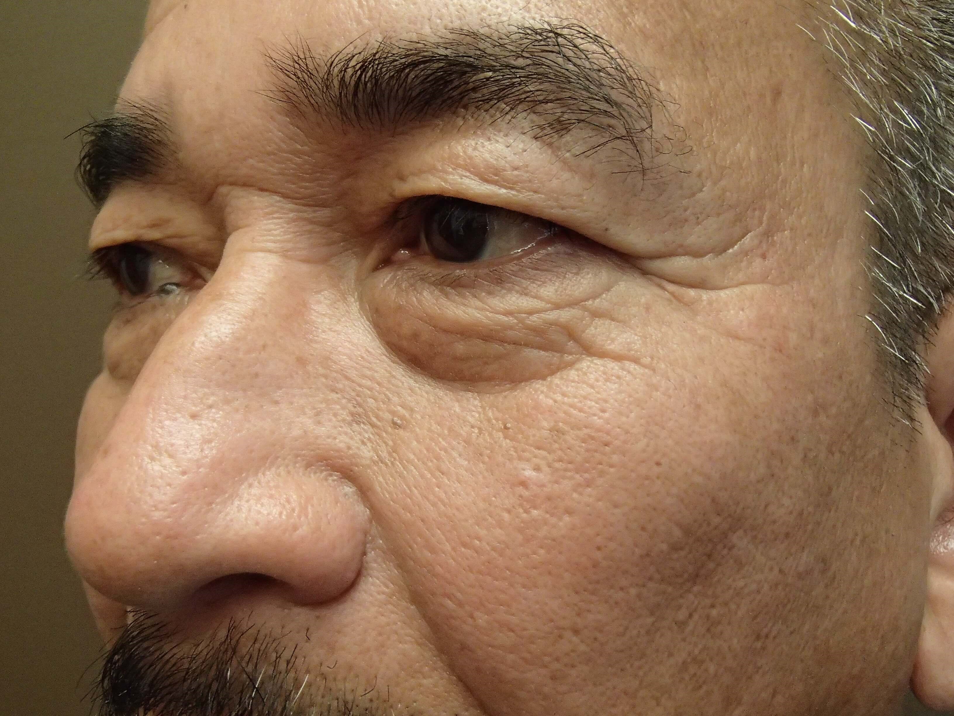 Asian Eyelid Lift Before