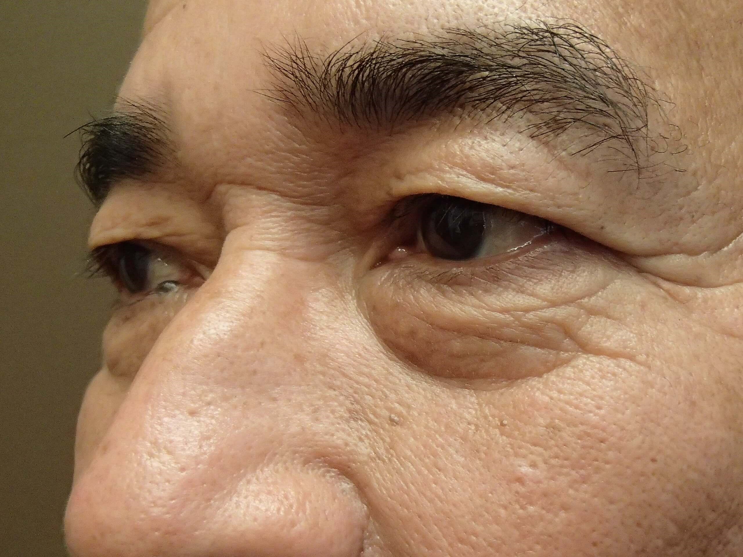 Asian Eyelid Lift Before