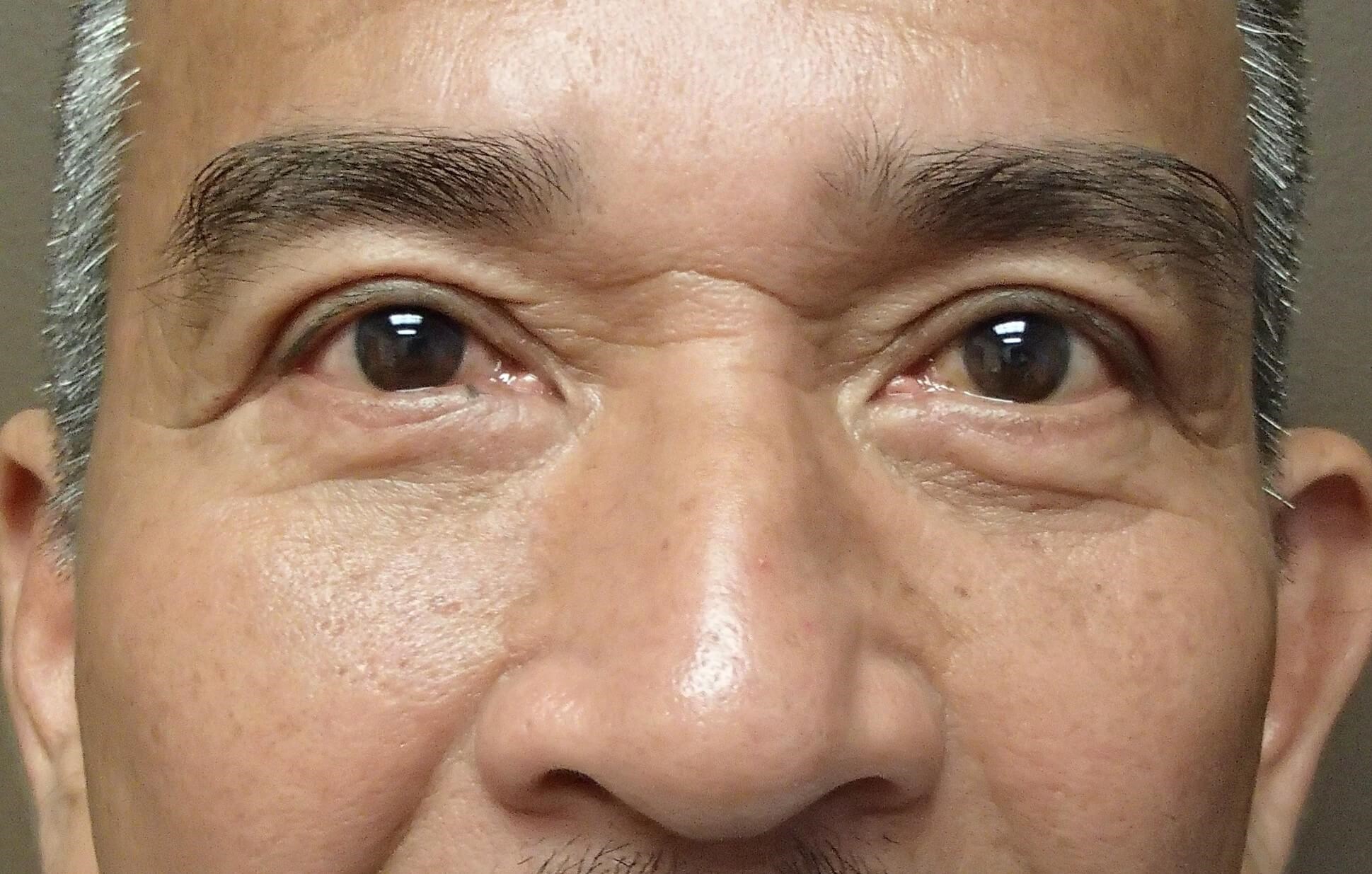 Asian Eyelid Lift After
