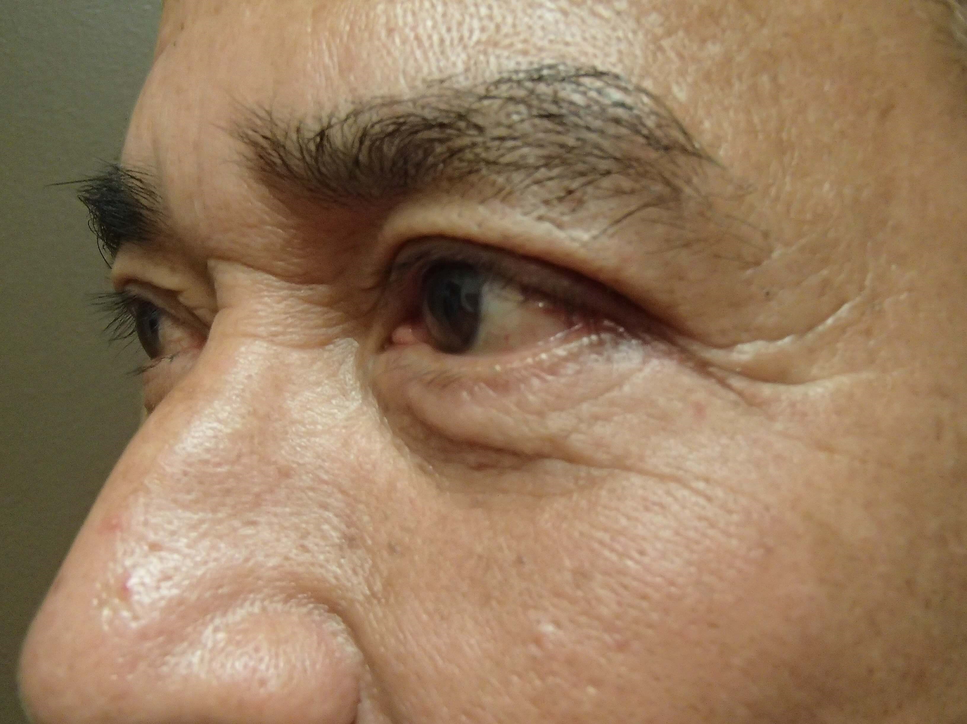 Asian Eyelid Lift After