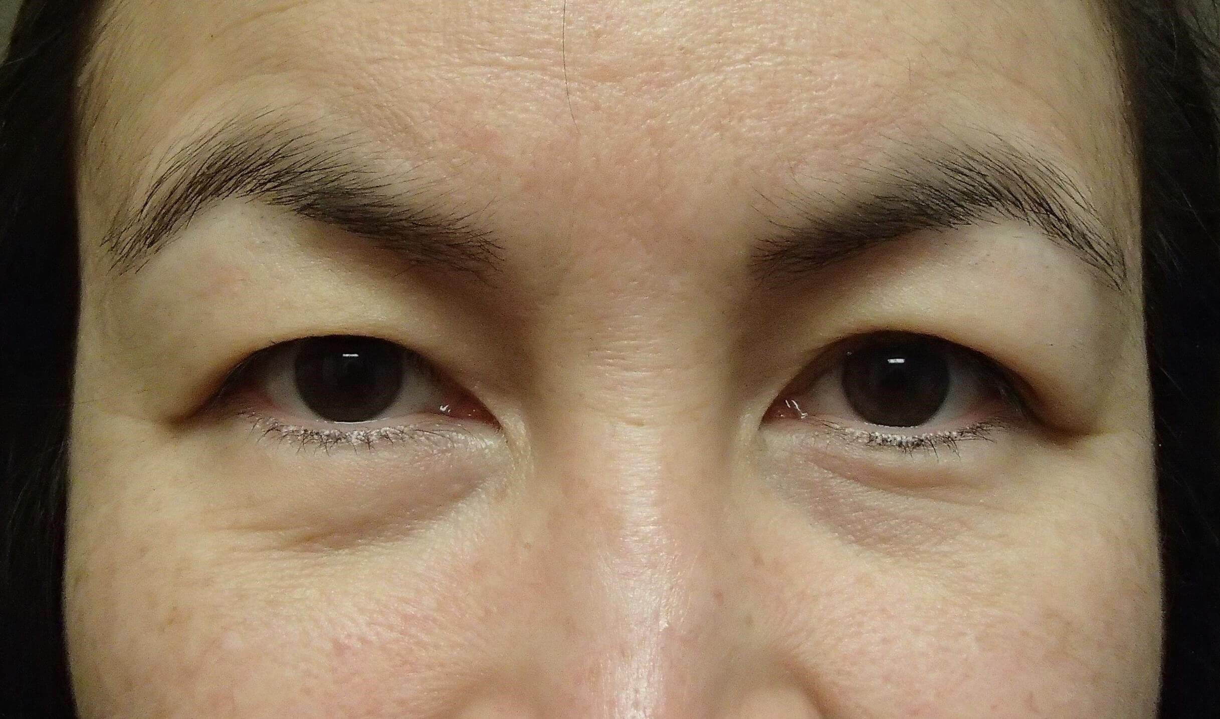 Asian Eyelid Lift Before