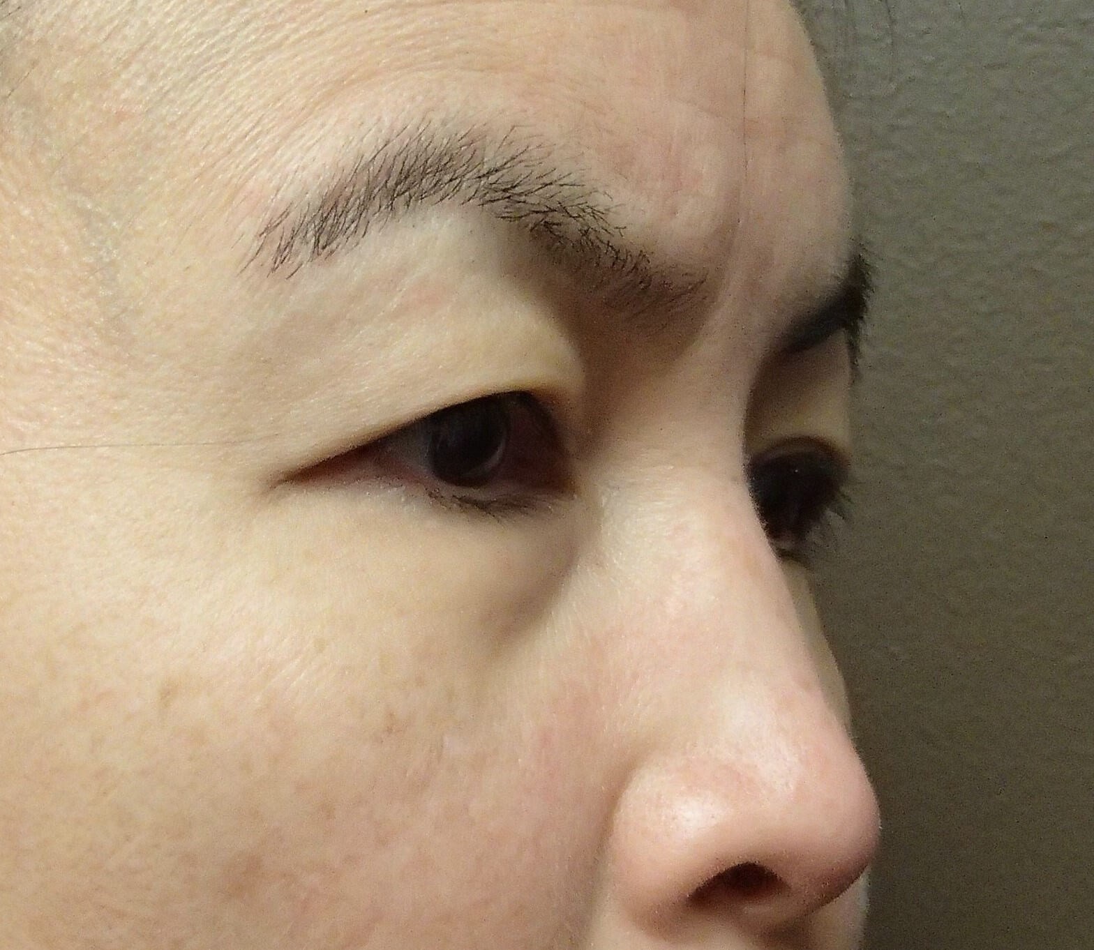Asian Eyelid Lift Before