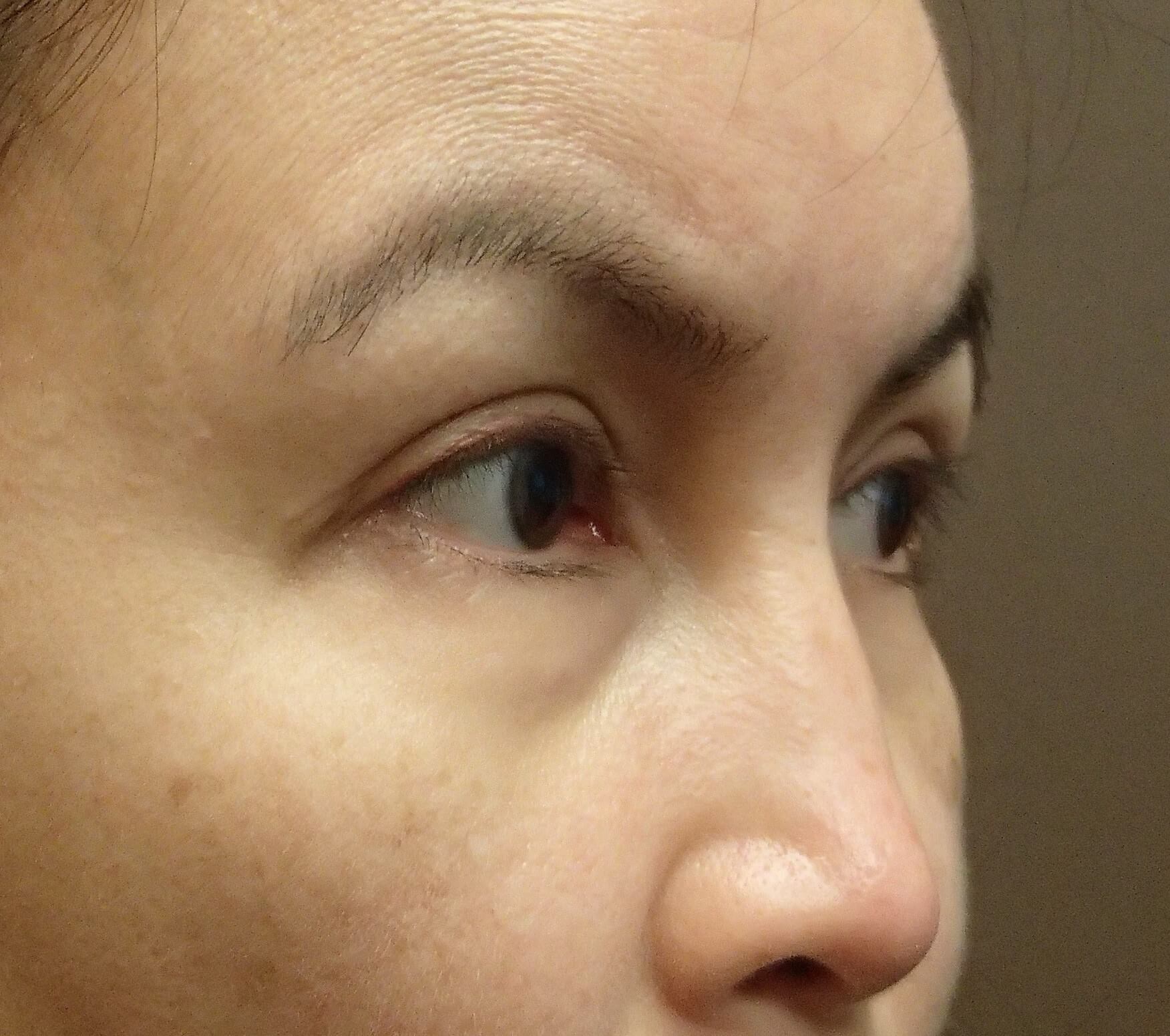 Asian Eyelid Lift After