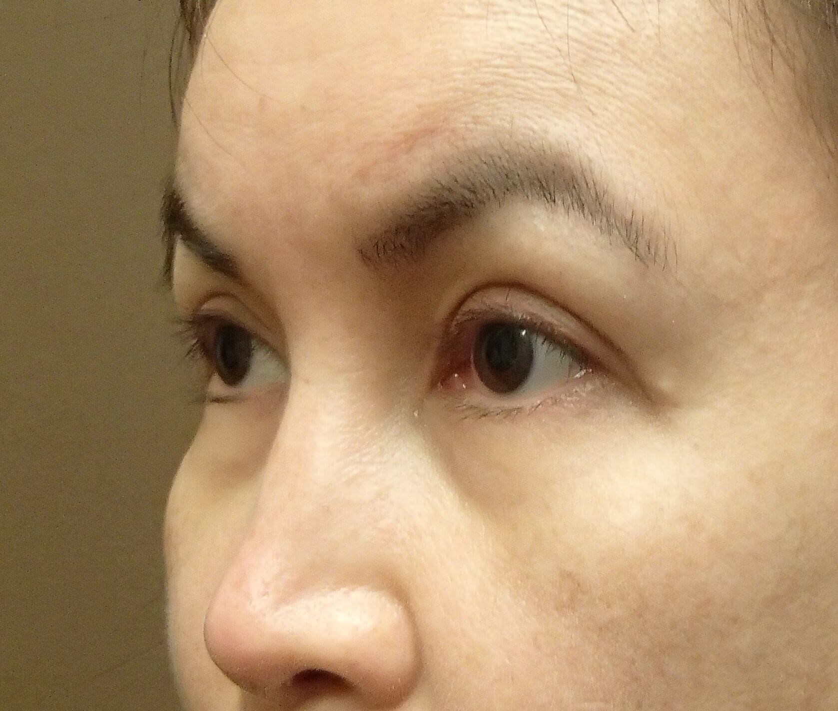 Asian Eyelid Lift After