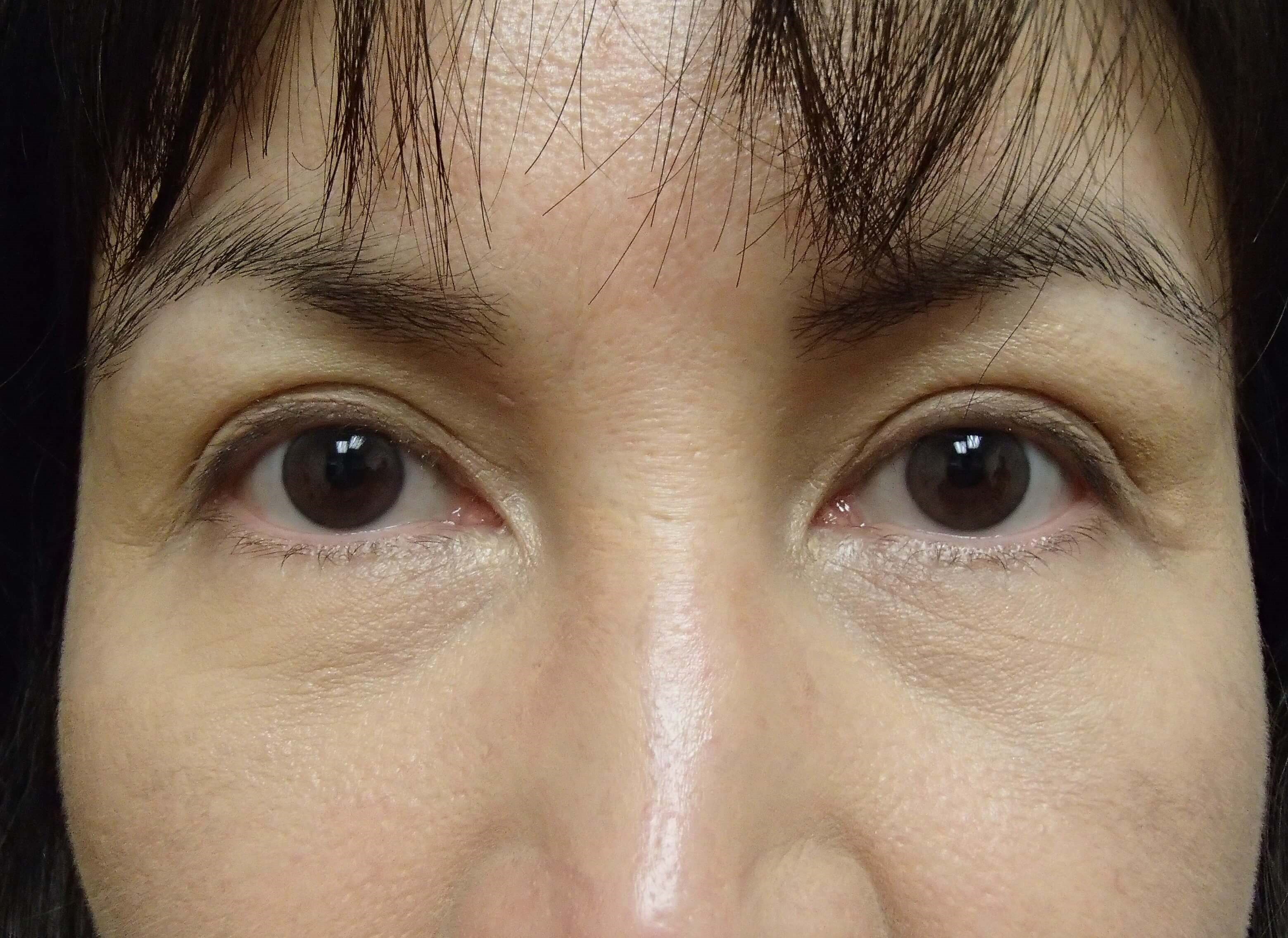 Asian Eyelid Lift After