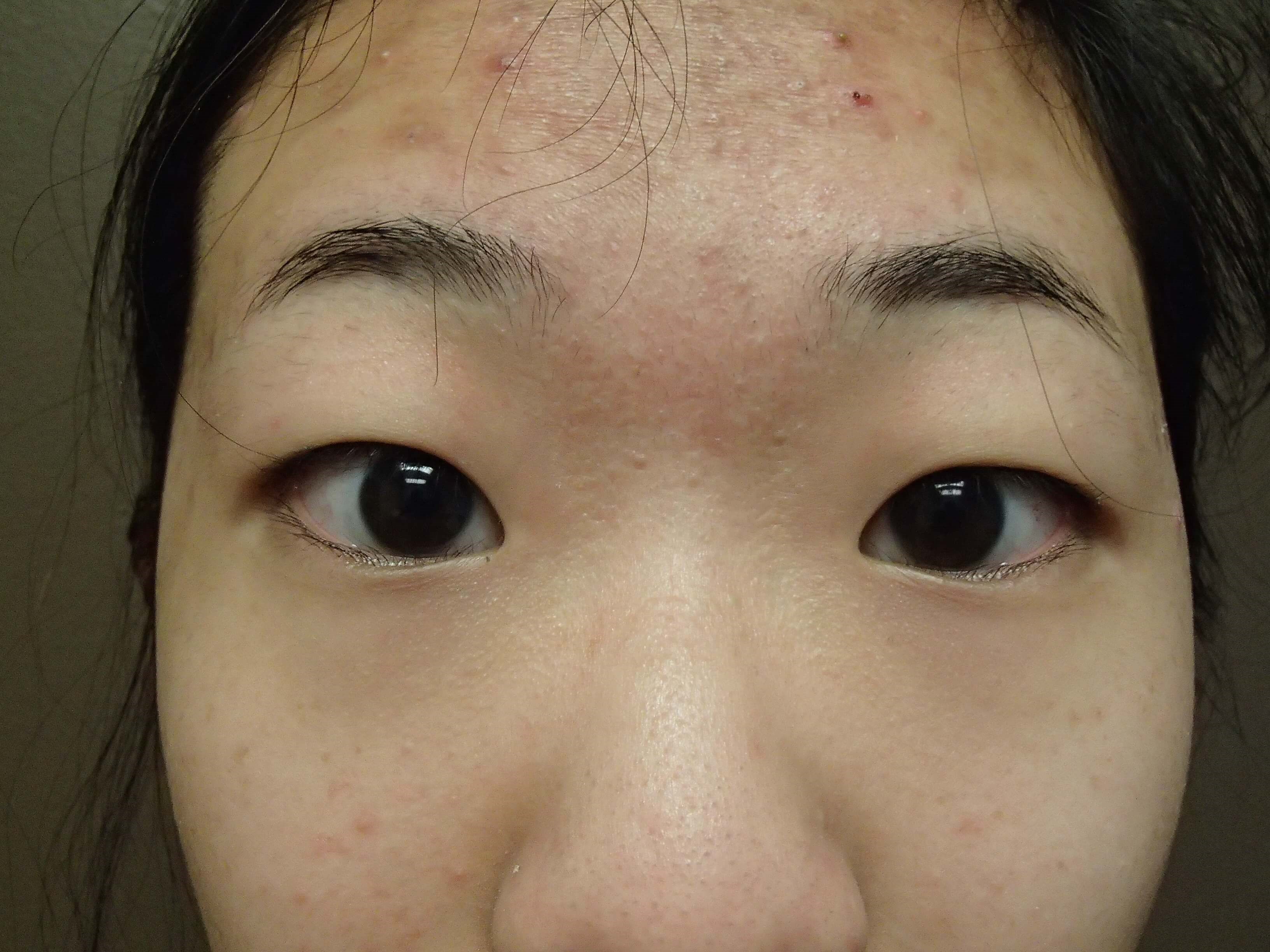 Asian Eyelid Lift Before