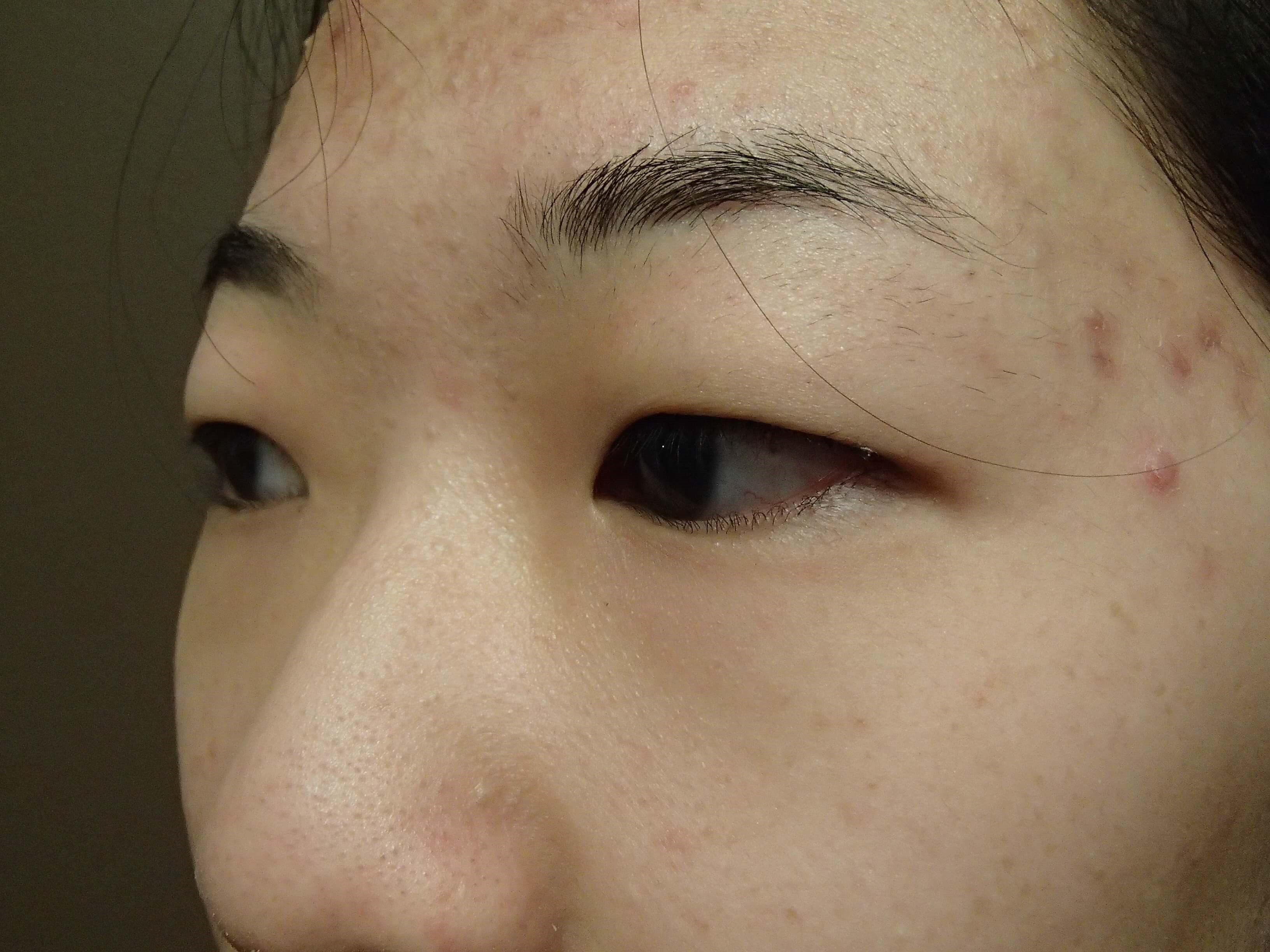 Asian Eyelid Lift Before