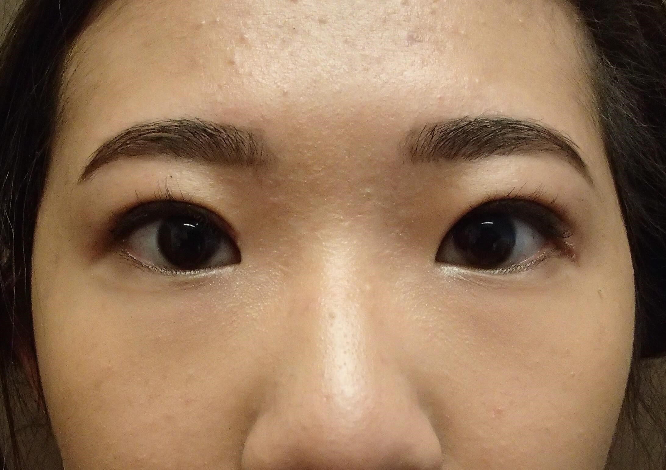 Asian Eyelid Lift After
