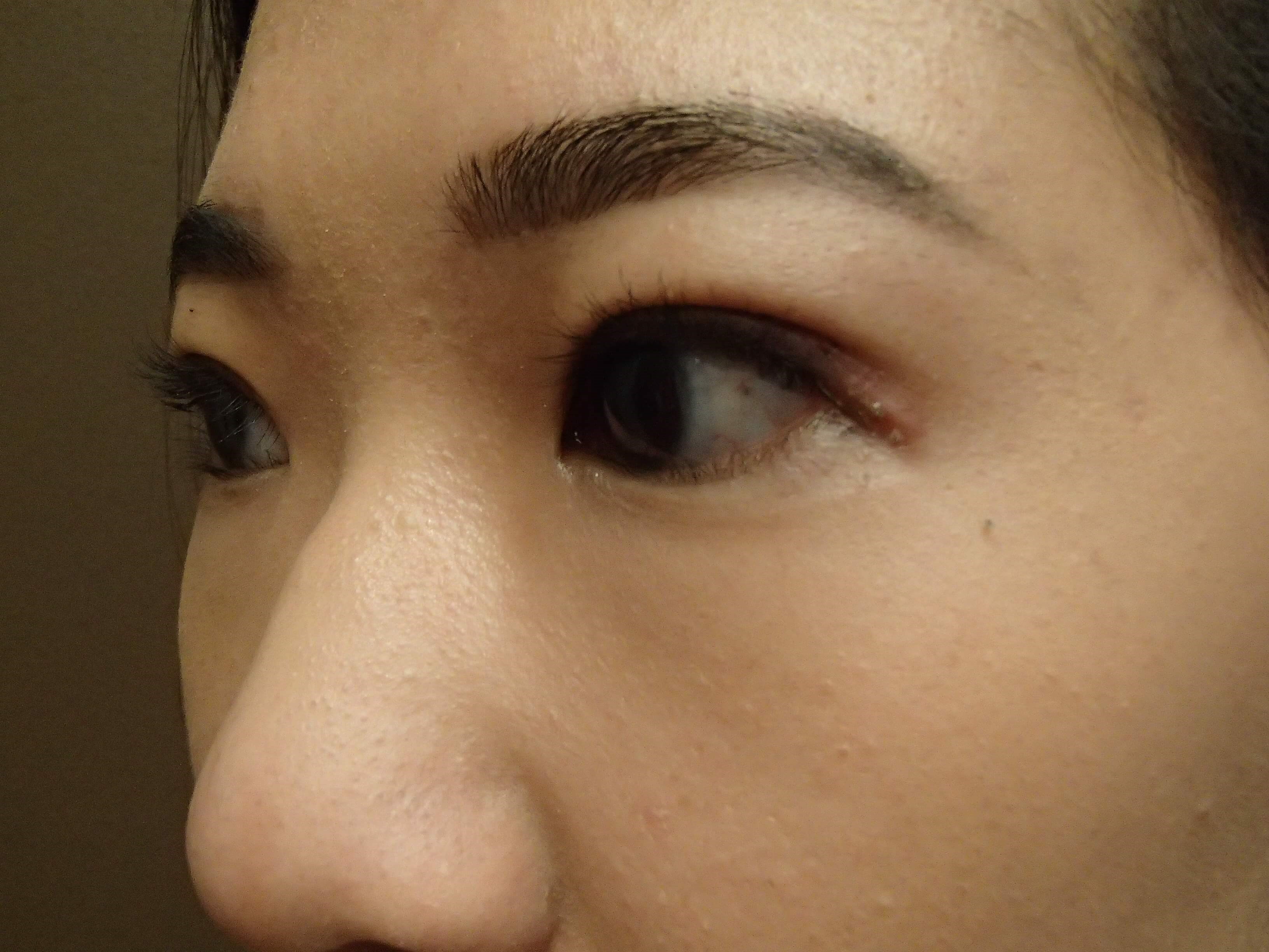 Asian Eyelid Lift After