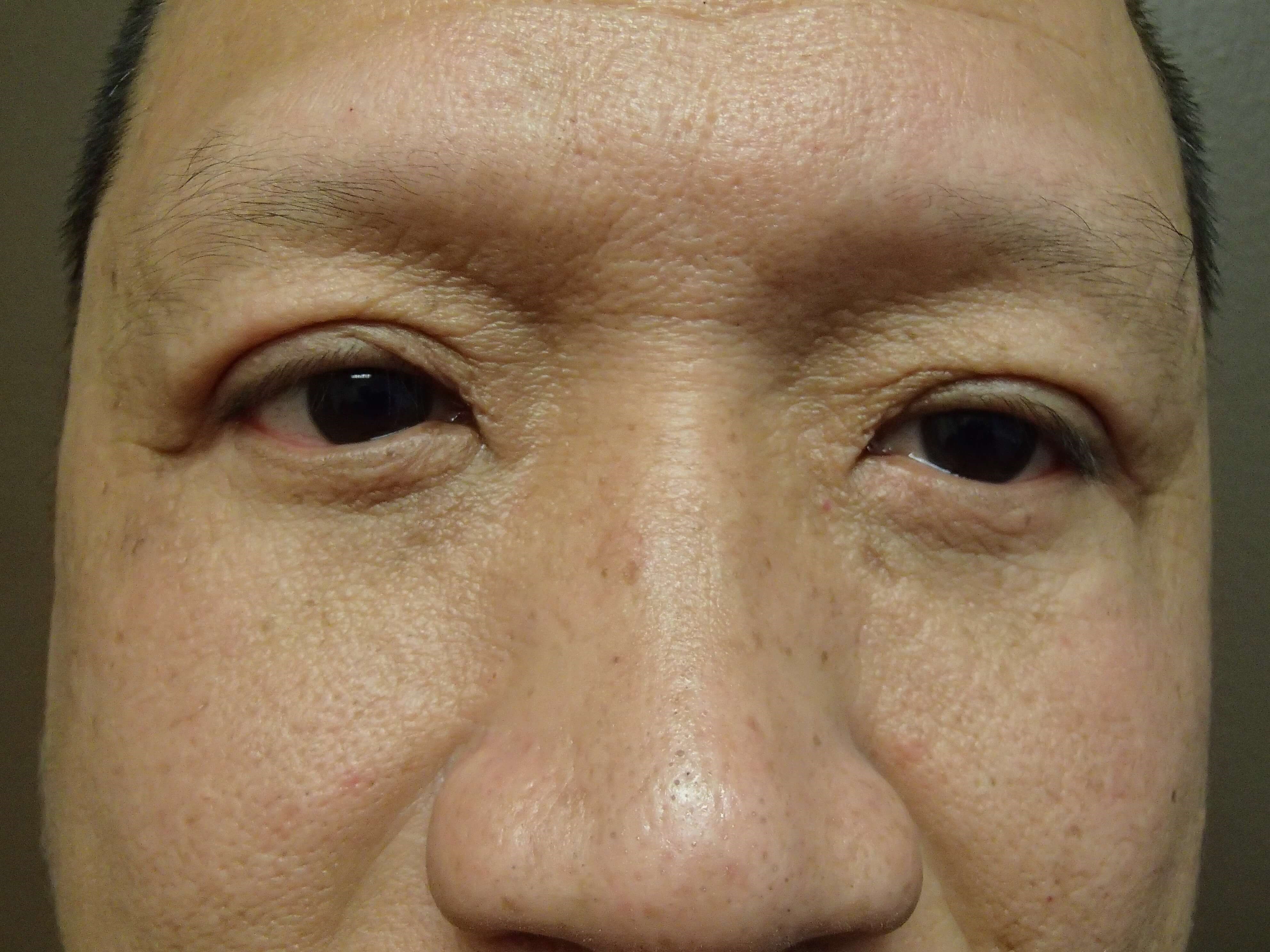 Asian Eyelid Lift After