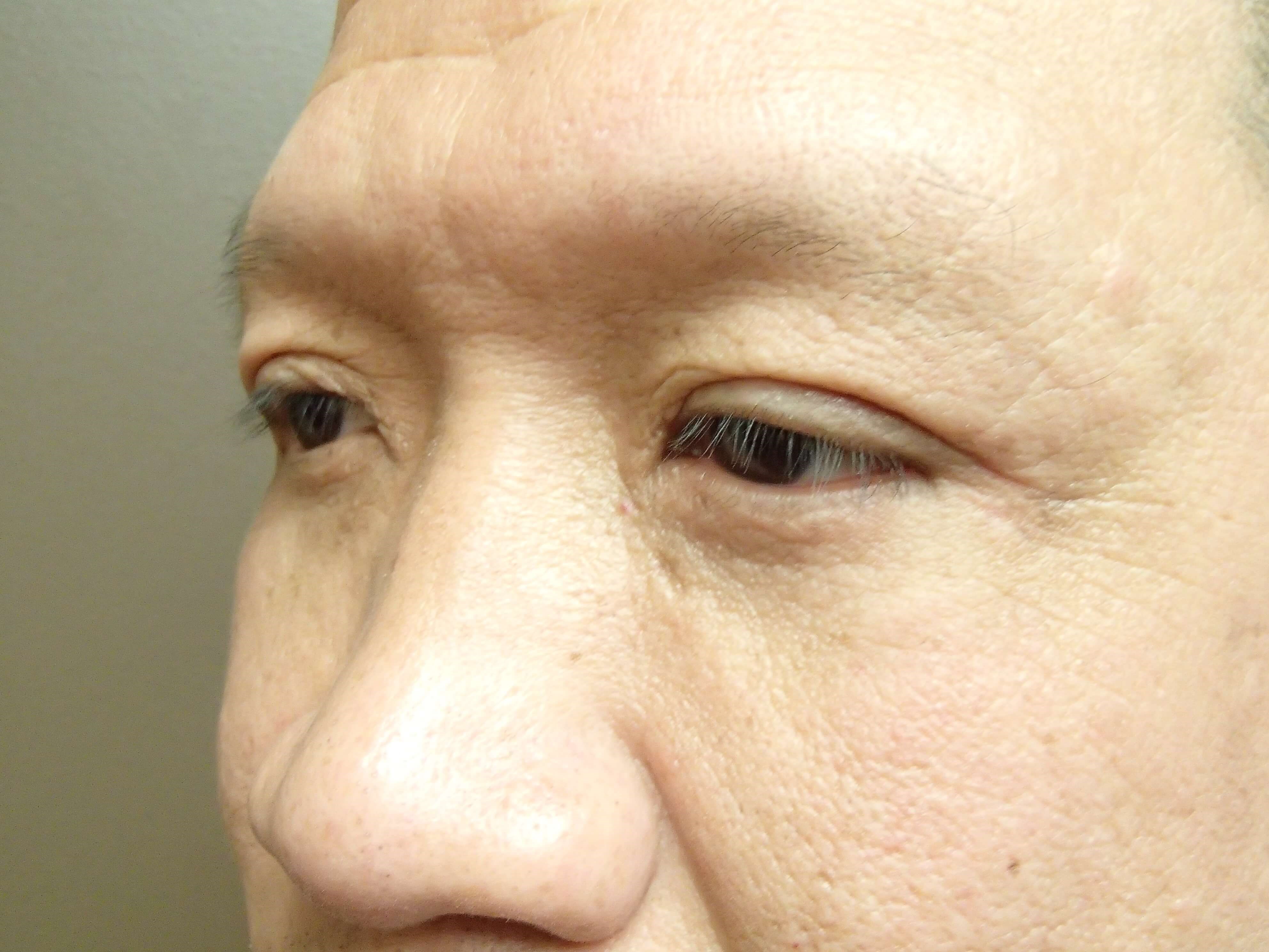 Asian Eyelid Lift After