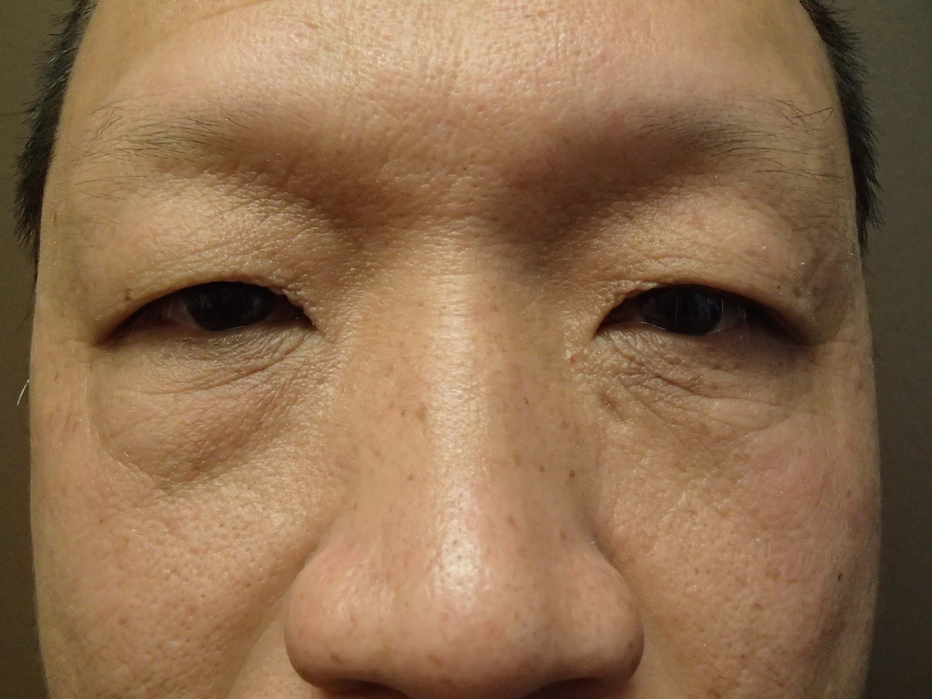 Asian Eyelid Lift Before
