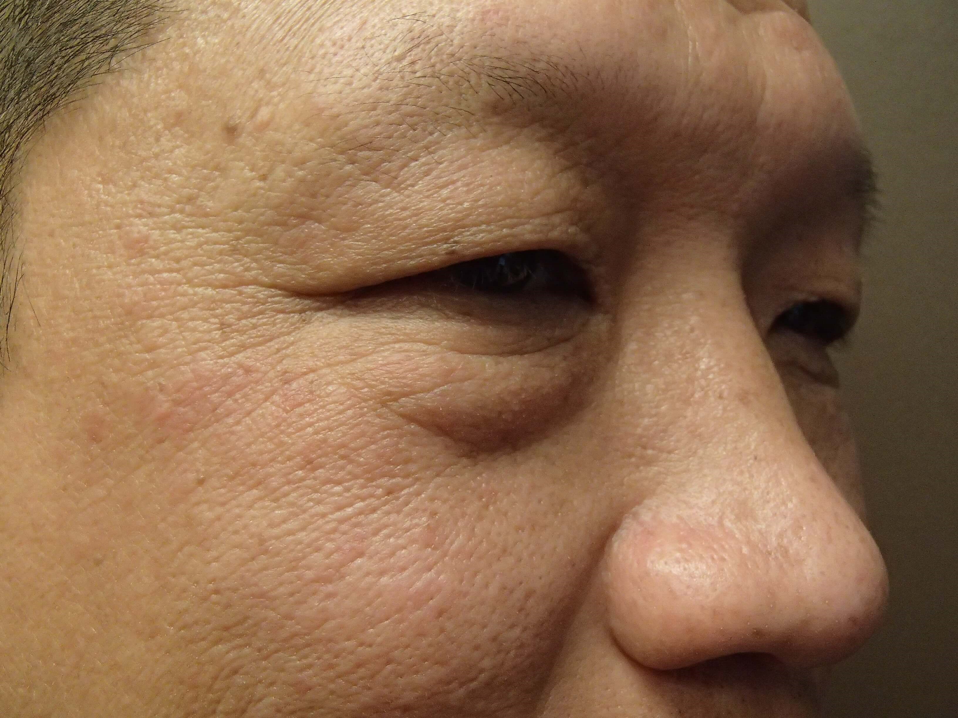 Asian Eyelid Lift Before