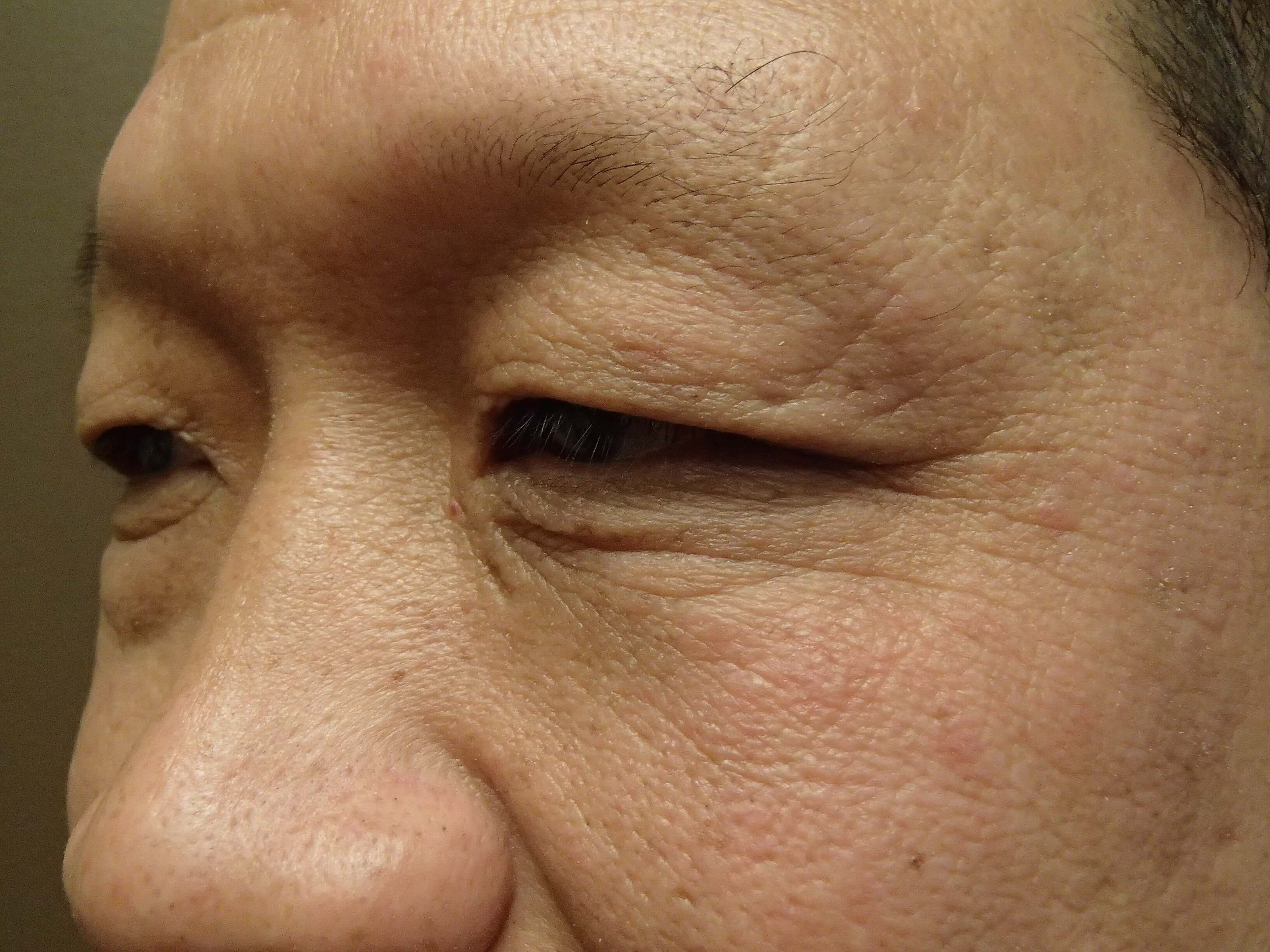 Asian Eyelid Lift Before