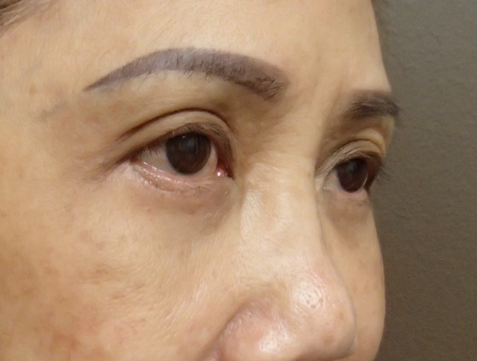 Asian Eyelid Lift After