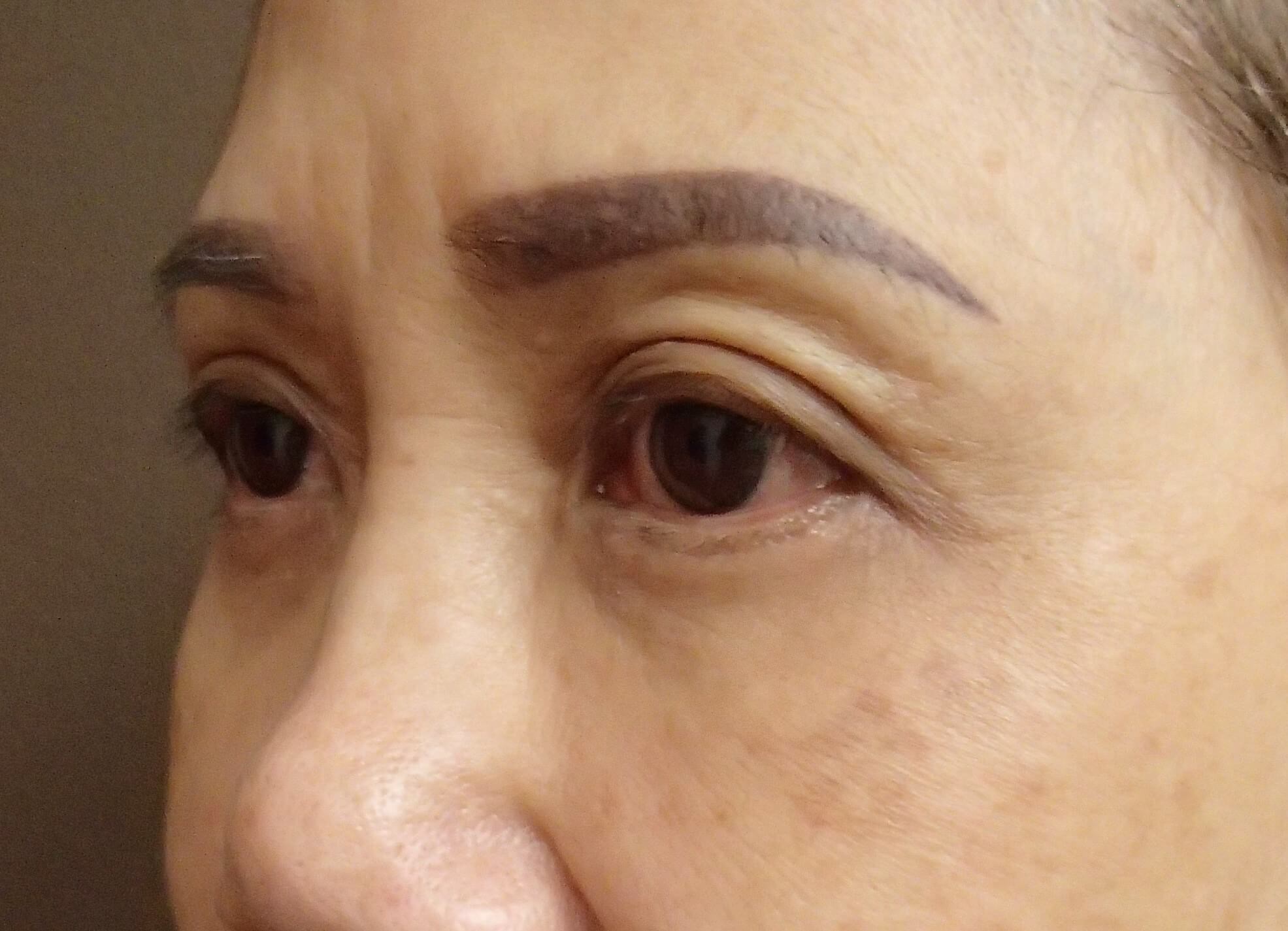 Asian Eyelid Lift After