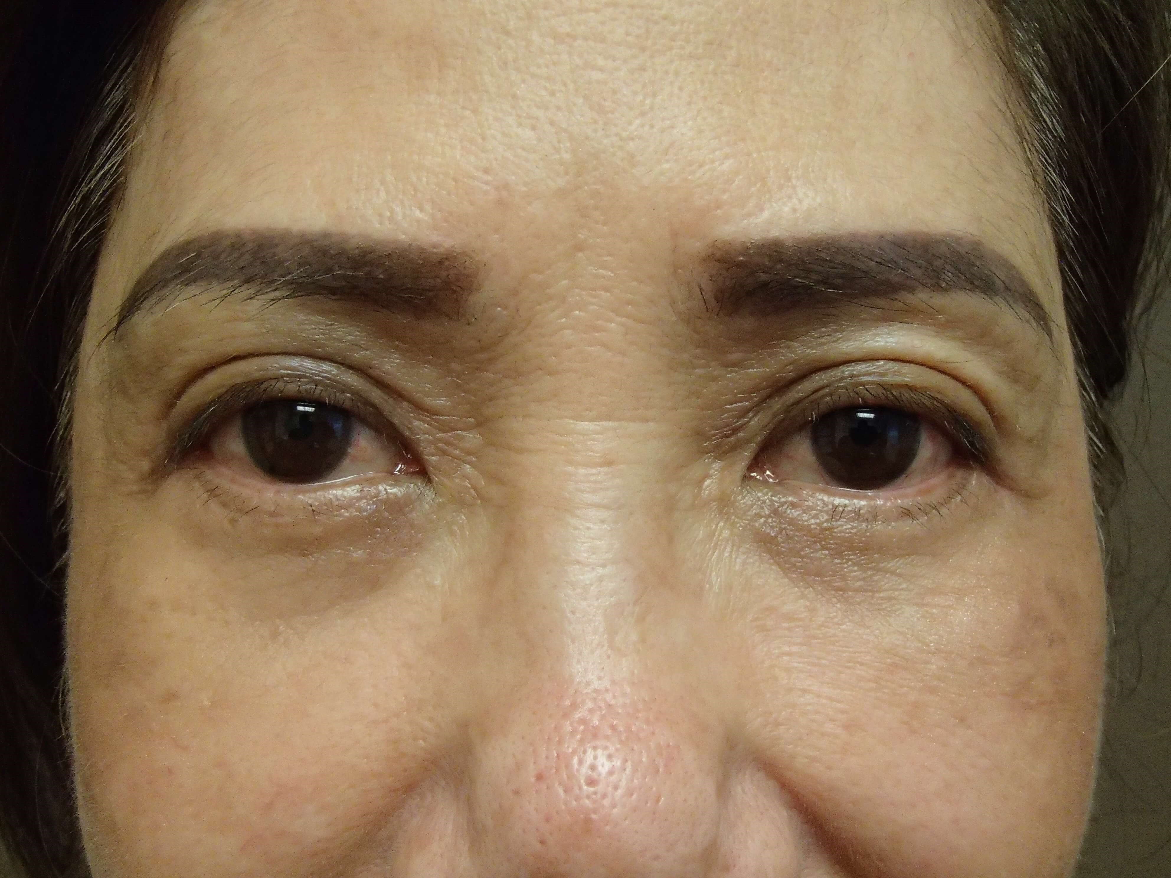 Asian Eyelid Lift After
