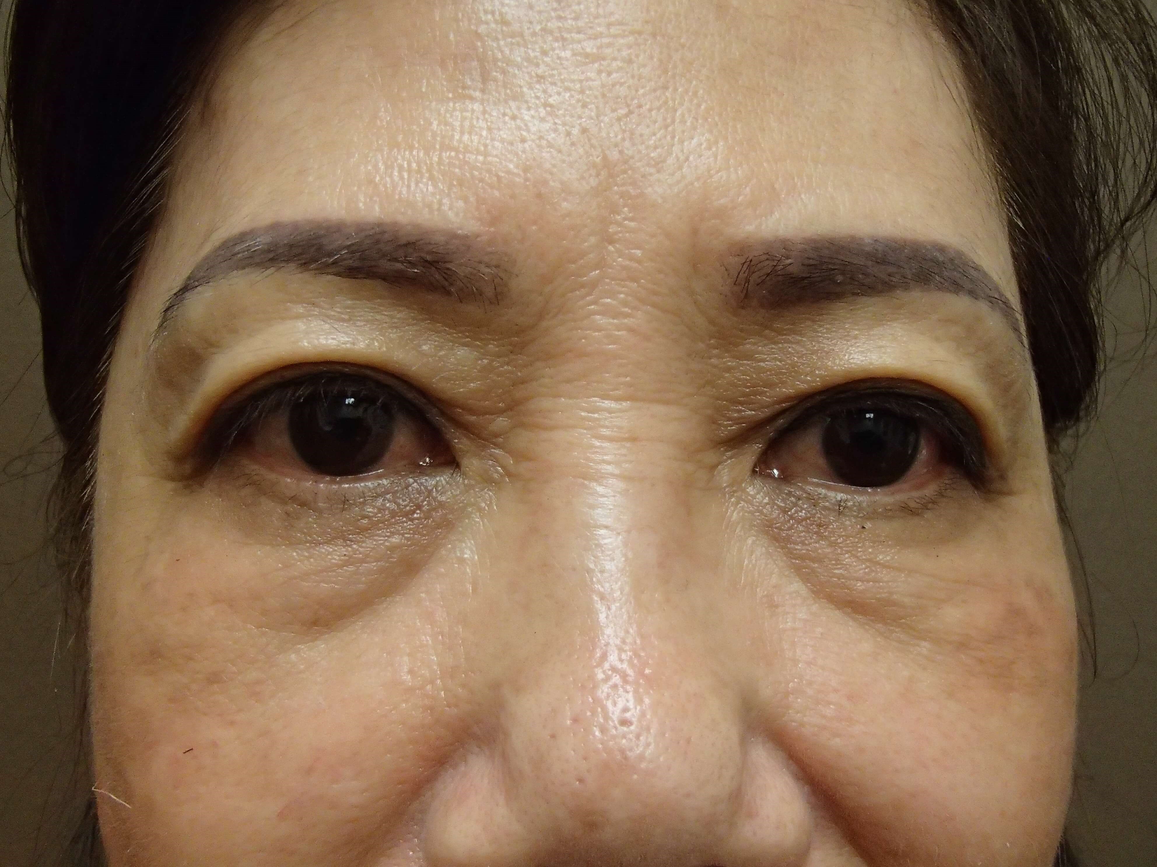 Asian Eyelid Lift Before