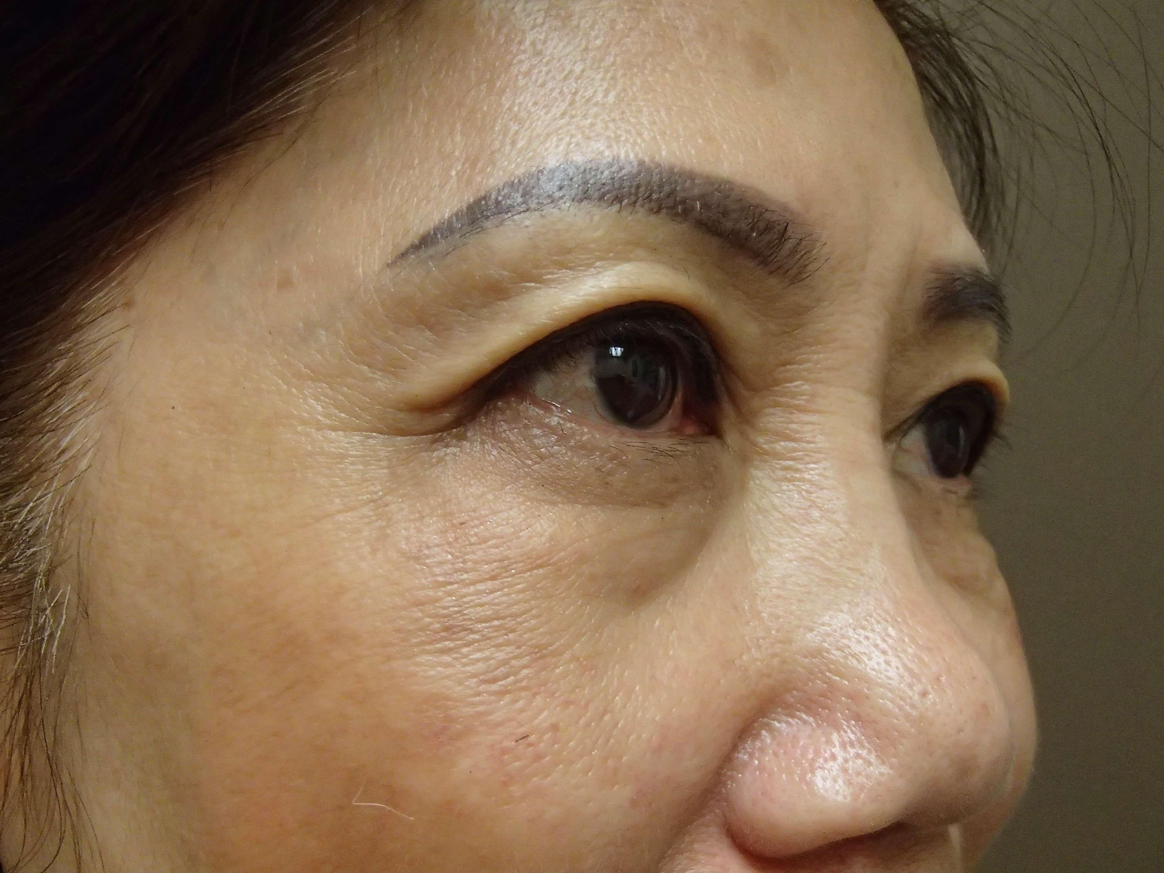 Asian Eyelid Lift Before