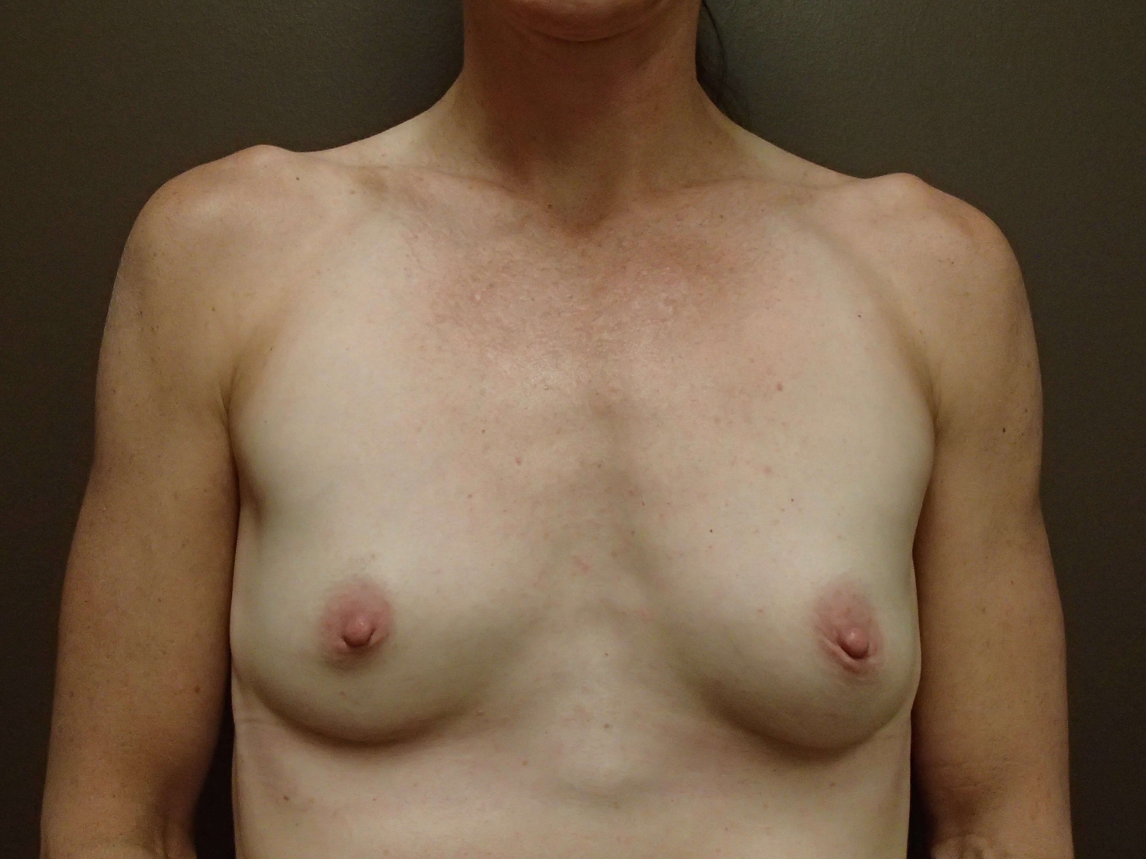 Breast Explant After