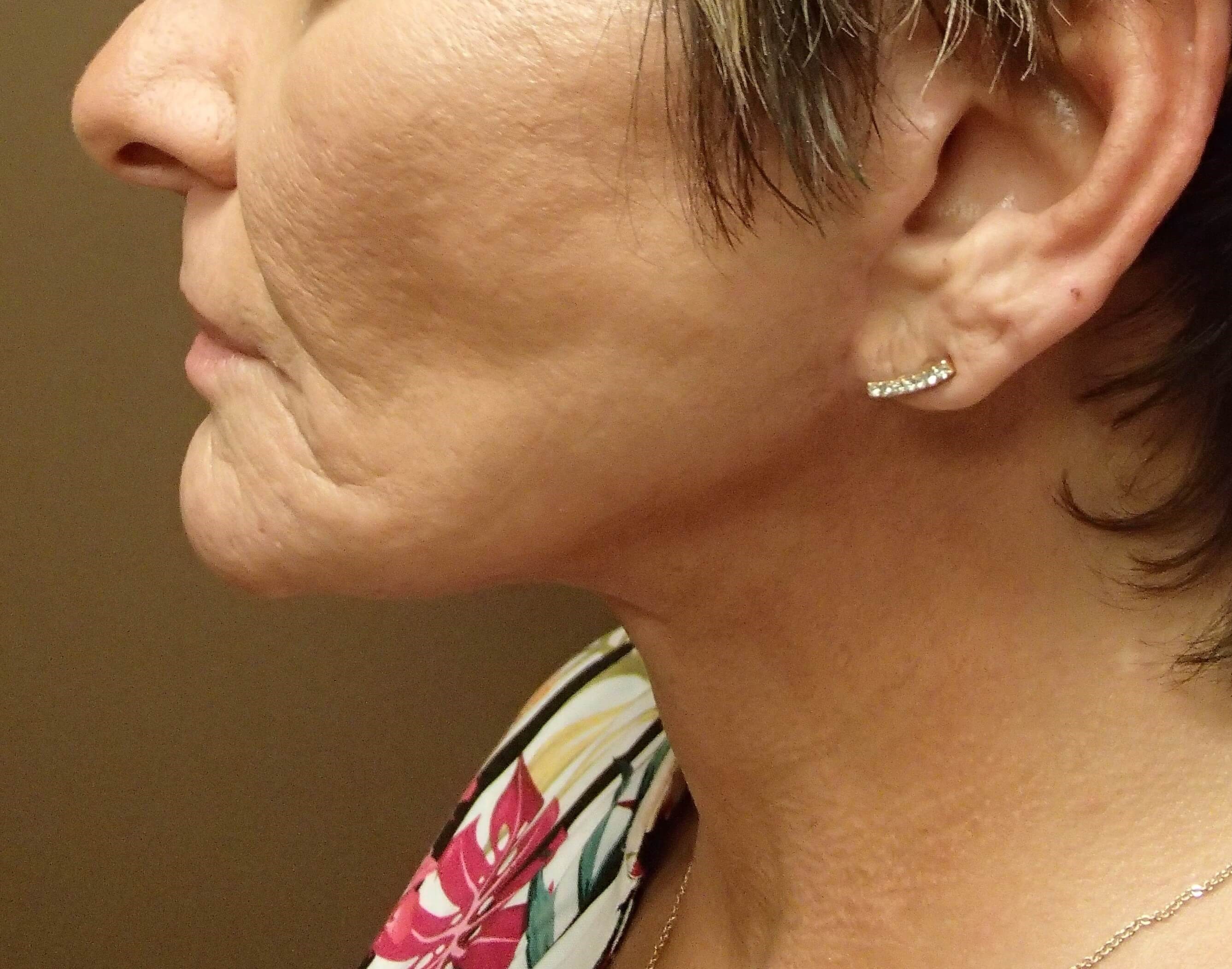Necklift After